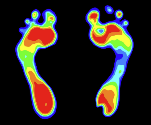 Foot pressure analysis heat map showing high pressure points and gait imbalance