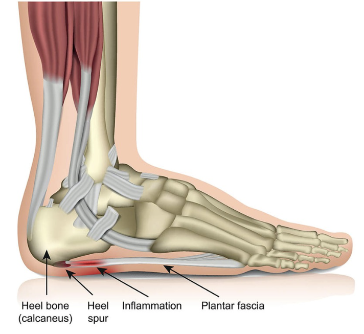 Plantar fasciitis and heel spur diagram showing causes of heel pain and foot inflammation