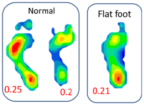Flat feet vs normal arch comparison with foot pressure distribution analysis