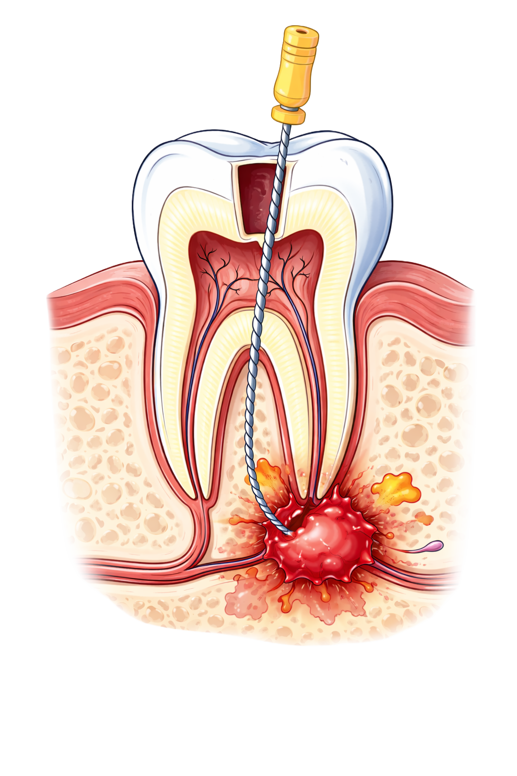Schnitt durch einen Zahn mit Wurzelkanalbehandlung, bei der eine Bohrhilfe in den Zahnhals eingesetzt wird, und eine Entzündung im Knochen um die Wurzelspitze sichtbar ist.