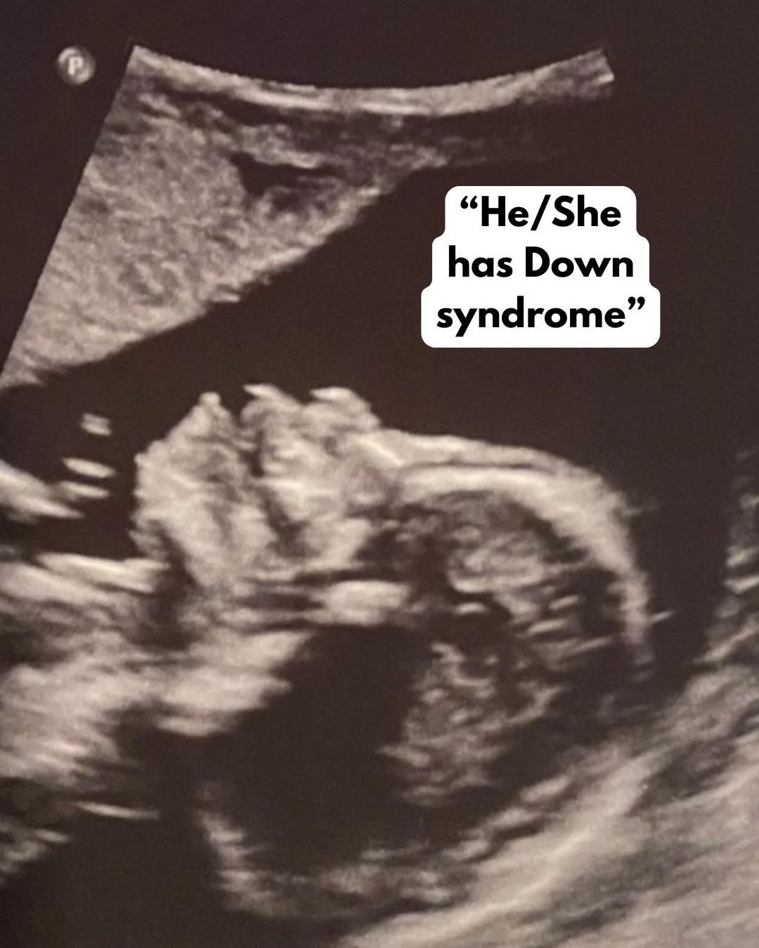 The real raw truth&hellip;

When a child is diagnosed with Down syndrome, the emotions that follow can be overwhelming. 

A Down syndrome diagnosis is life-altering. That&rsquo;s the simple truth. It changes the picture you may have had in your mind 