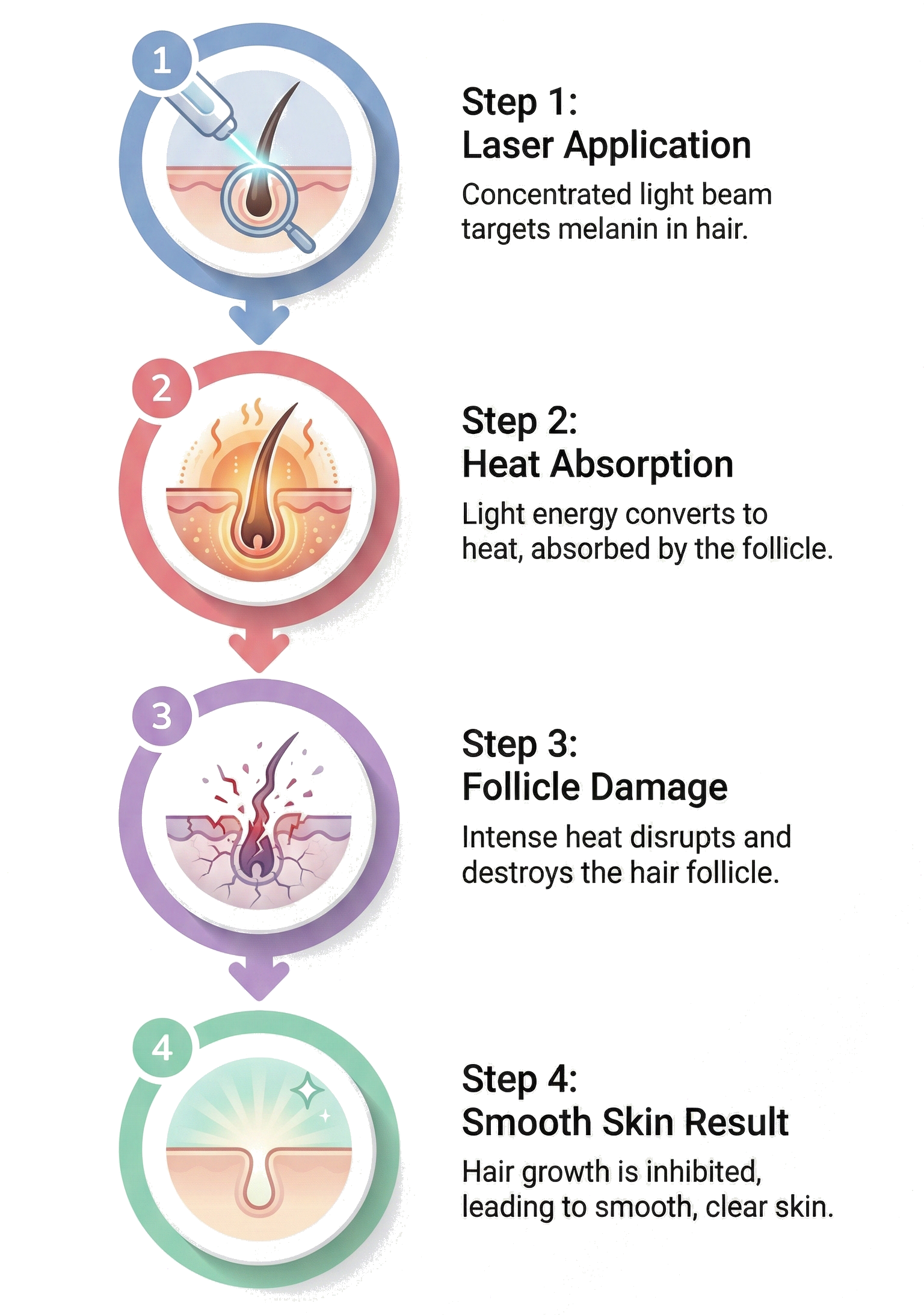 A four-step diagram illustrating a hair treatment process. Step 1: Laser application targeting melanin in hair, shown with a laser device aimed at a hair follicle. Step 2: Heat absorption by the follicle, depicted with heat waves around the hair follicle. Step 3: Follicle damage with intense heat disrupting and destroying the hair follicle. Step 4: Smooth skin results with a close-up of clear, healthy skin and inhibited hair growth.
