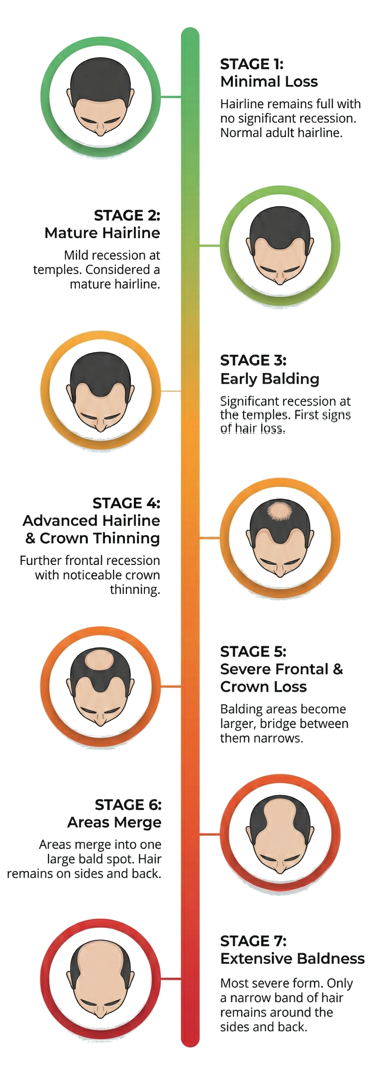 Progression of male hair loss stages from minimal loss with full hair, to mature hairline, early balding with recessed temples, advanced hairline thinning, severe frontal and crown loss with wide bald area, to complete baldness with no hair.