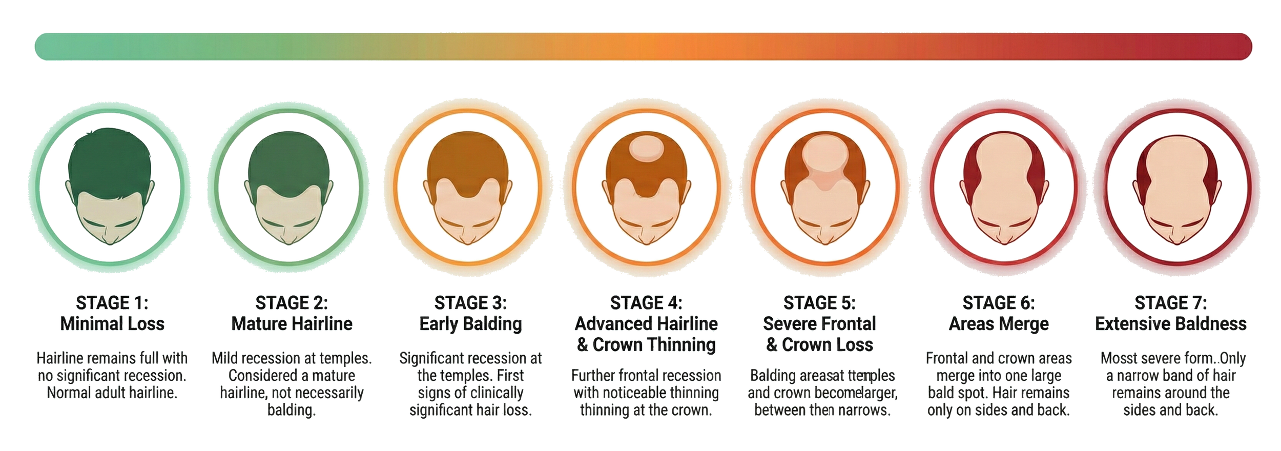 A diagram showing the stages of hair loss, starting from minimal loss with a full hairline and progressing through moderate balding, advanced thinning, severe frontal and crown loss, areas merging, and extensive baldness, with colored outlines around each stage indicating the severity of hair loss.