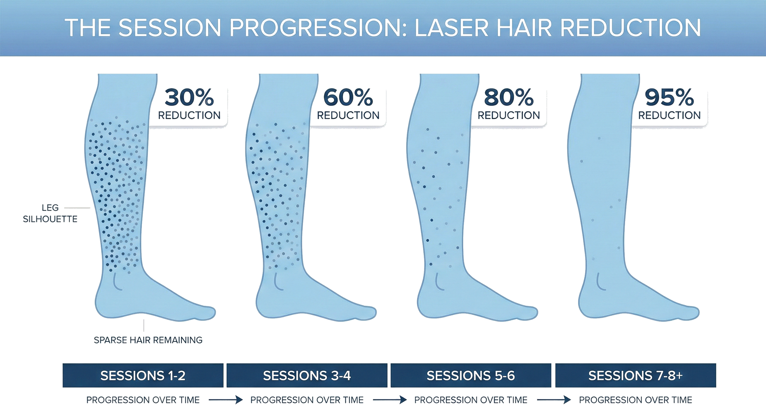 Diagram illustrating laser hair reduction session progression showing decreasing hair density in the leg over four stages, with percentages indicating hair reduction: 30%, 60%, 80%, and 95%. The diagram has four foot-long vertical sections labeled with session numbers 1-2, 3-4, 5-6, and 7-8+, depicting progression over time.