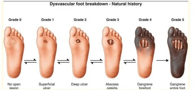 tissue loss in pad at cleveland clinic limb salvage program