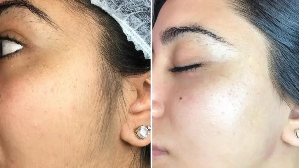 dermaplaning_before_and_after-1296x728-body_2-1024x575.webp