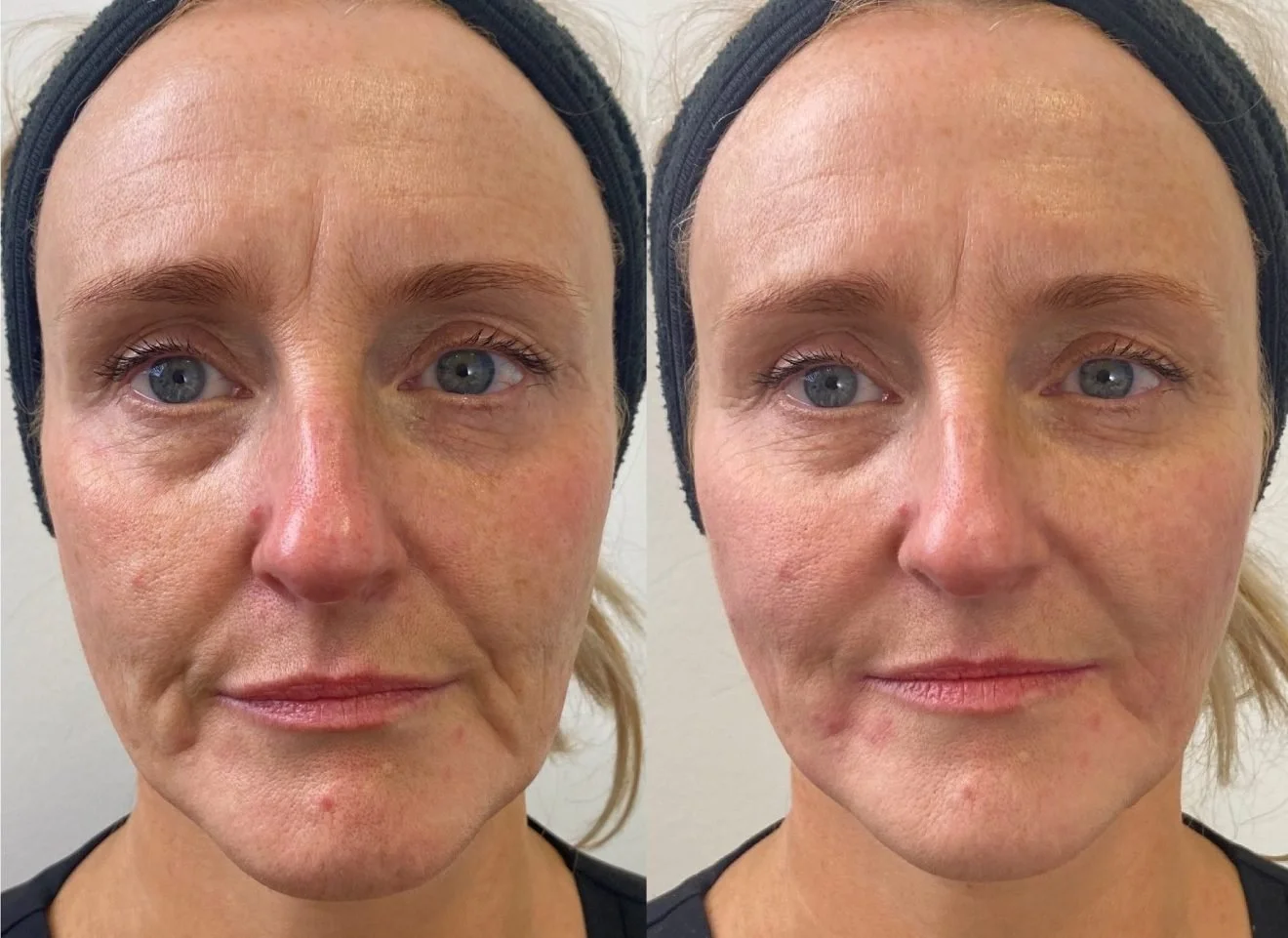 Lower-Face-Lift-with-Dermal-Fillers-Before-and-After-by-Dr-Johanna-Ward-1320x961.jpg