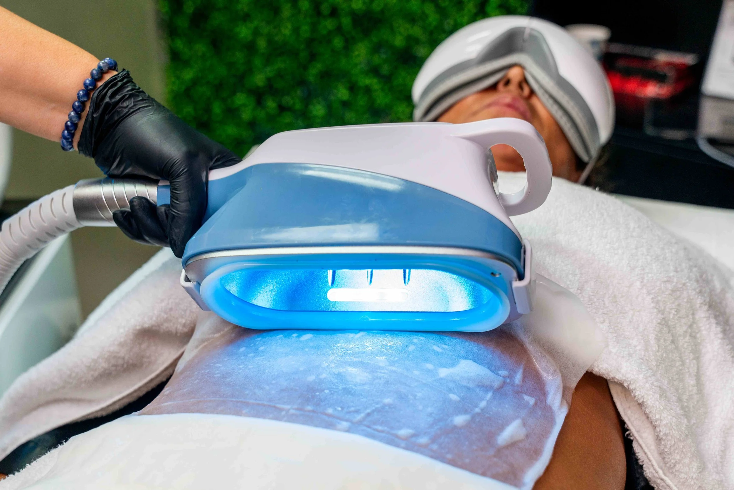 Client undergoing a Cryolipo 360 treatment on the abdomen with blue LED light, lying on a bed and wearing eye massage glasses while a technician operates the device.