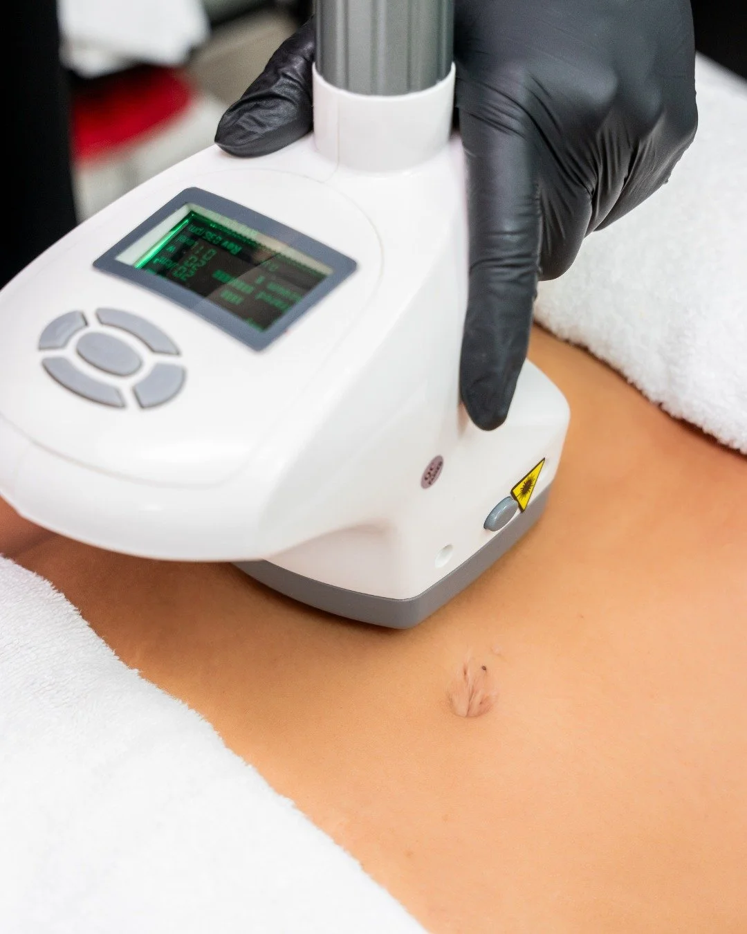 Cryo-Velashape

Redefine your contours. Indulge in the artistry of Cryo-Velashape&mdash;a harmonious fusion of deep cooling and gentle warmth that invites your body to awaken its natural elegance. Experience the effortless refinement of smooth, sculp