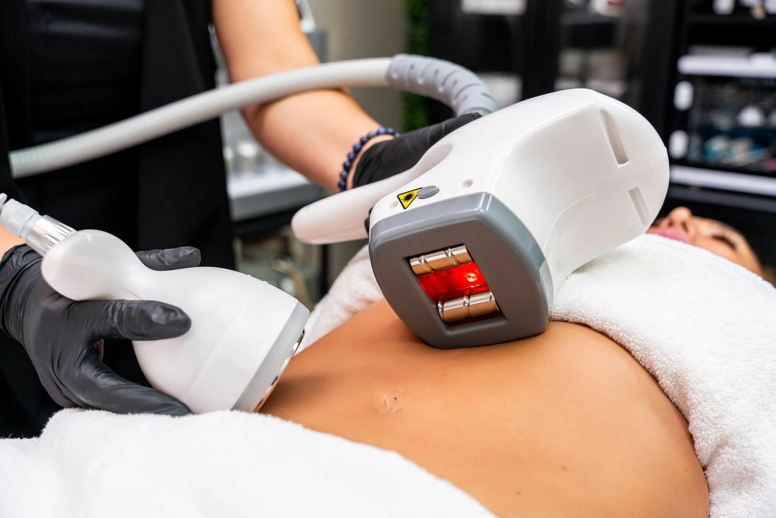 Velashape and 80K cavitation treatment being performed on a client’s abdomen at Wakashe Spa, with handheld devices operated by a trained technician.