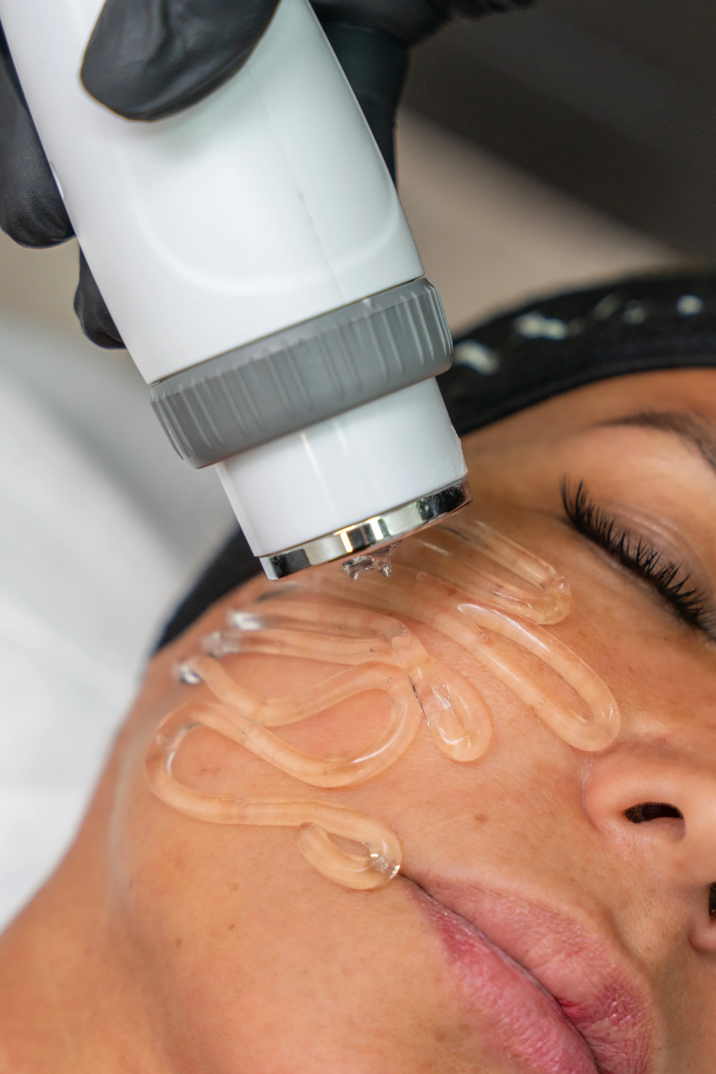 Client receiving Cold RF treatment on the face, with a technician wearing black gloves operating the device.