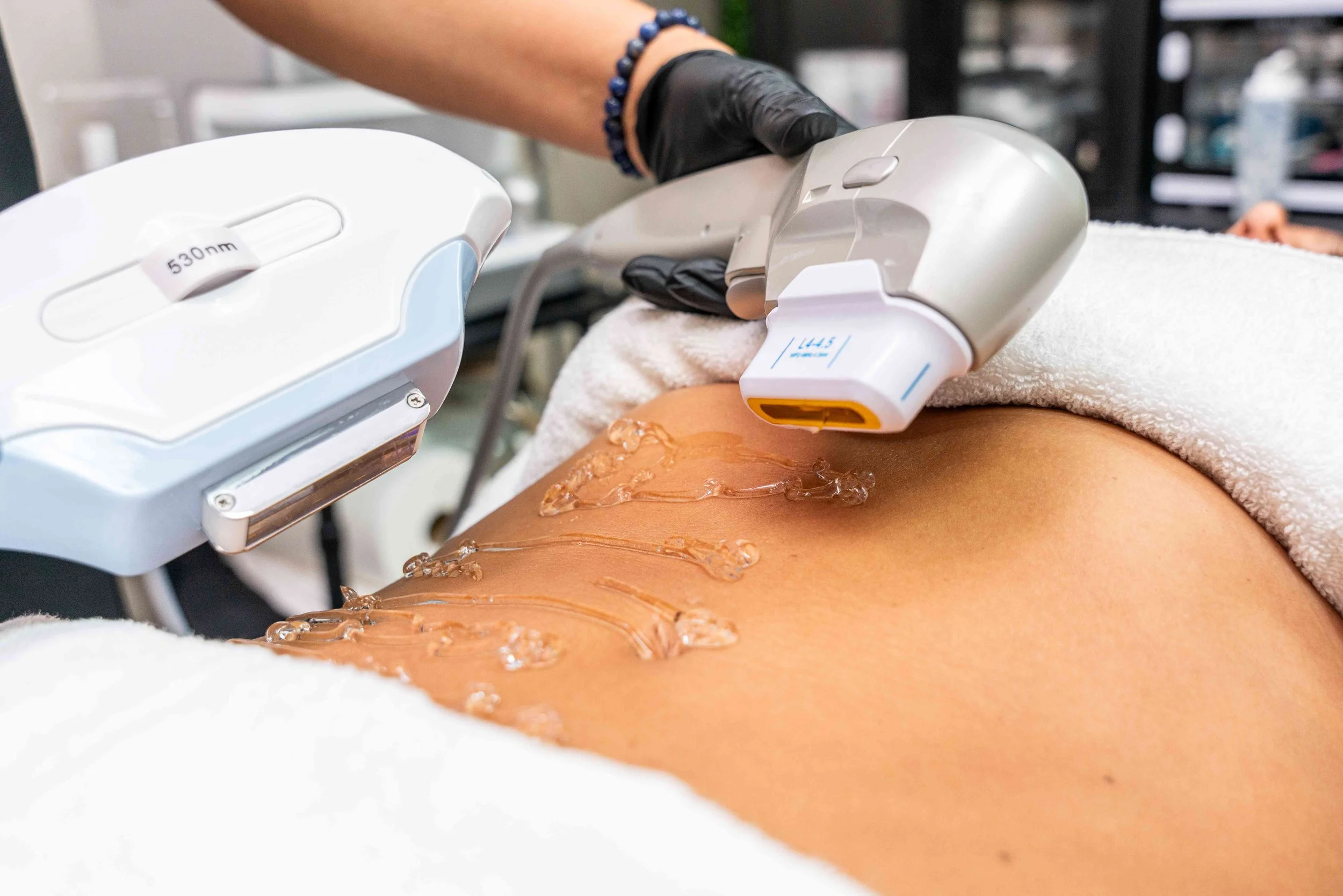 Client receiving IPL and 12D HIFU treatment on the abdomen, with a technician positioning both devices above the stomach.