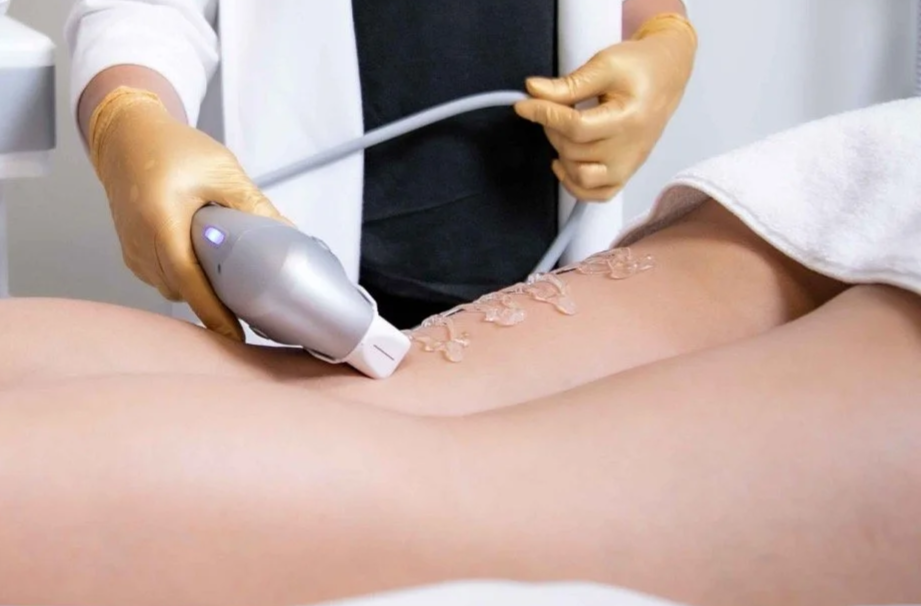 Client receiving hifu 12D treatment on the legs, with a technician wearing gold gloves operating the handpiece.