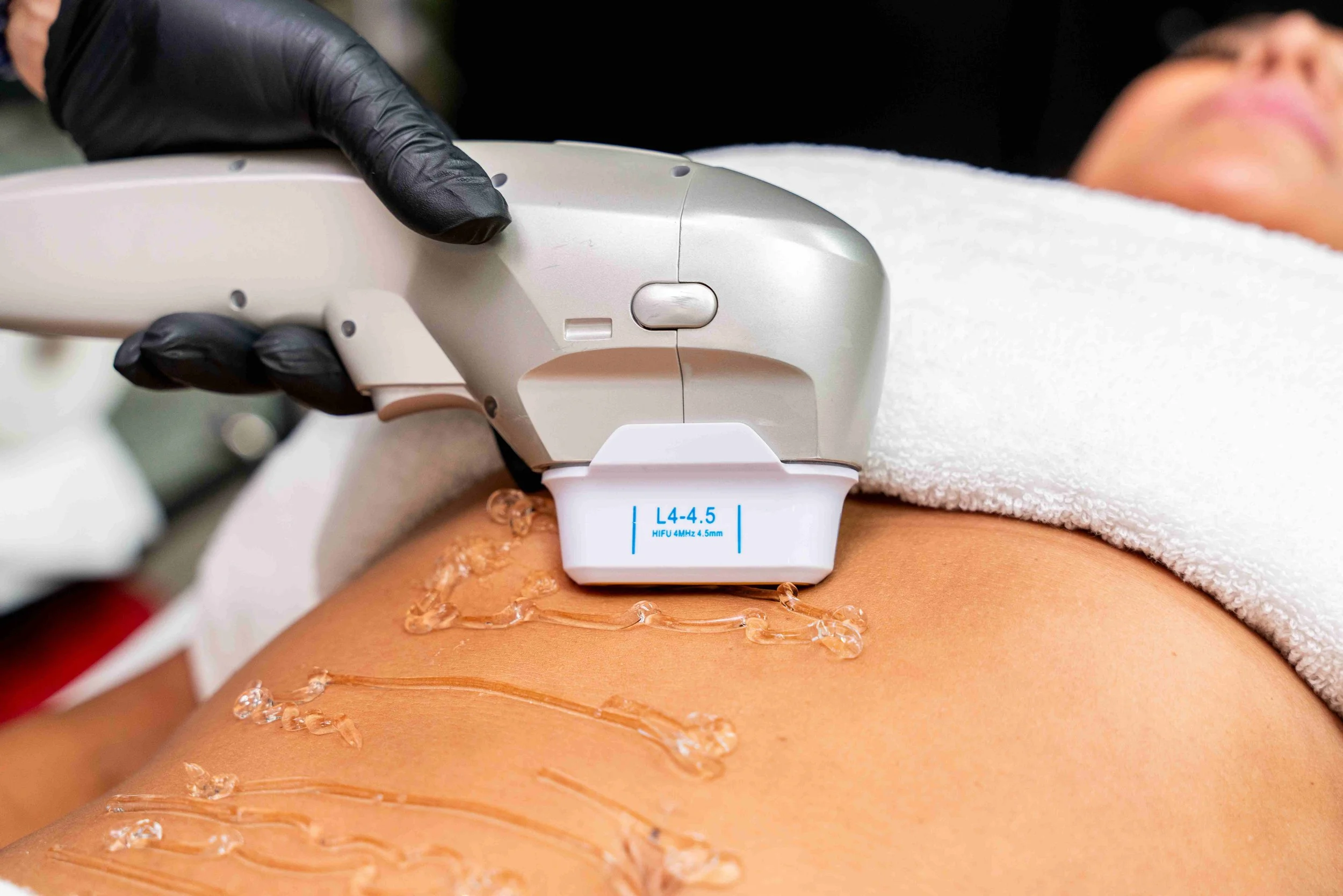 A person undergoing a hifu 12D treatment on their abdomen, with gel applied to the skin, while lying down with a towel covering their upper body.