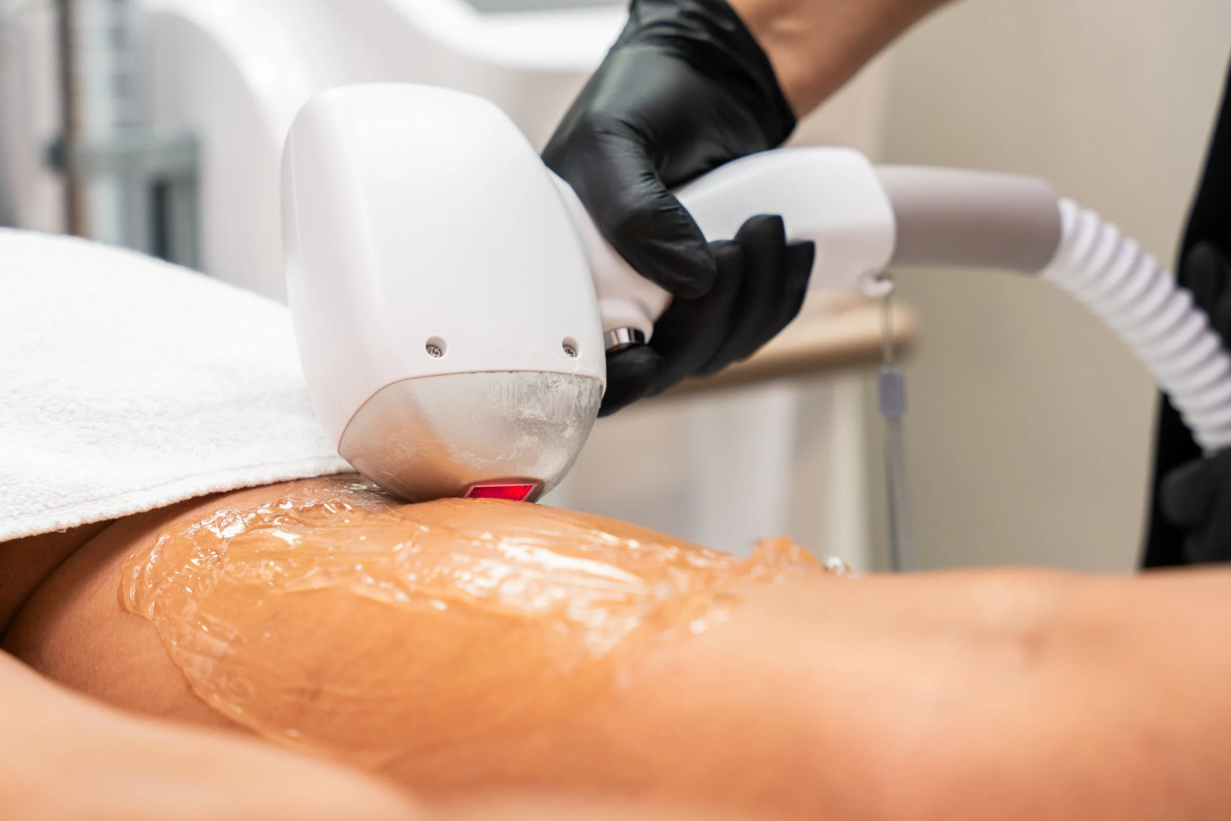 A client receiving a diode hair removal treatment on her legs, with a technician wearing black gloves operating the device.