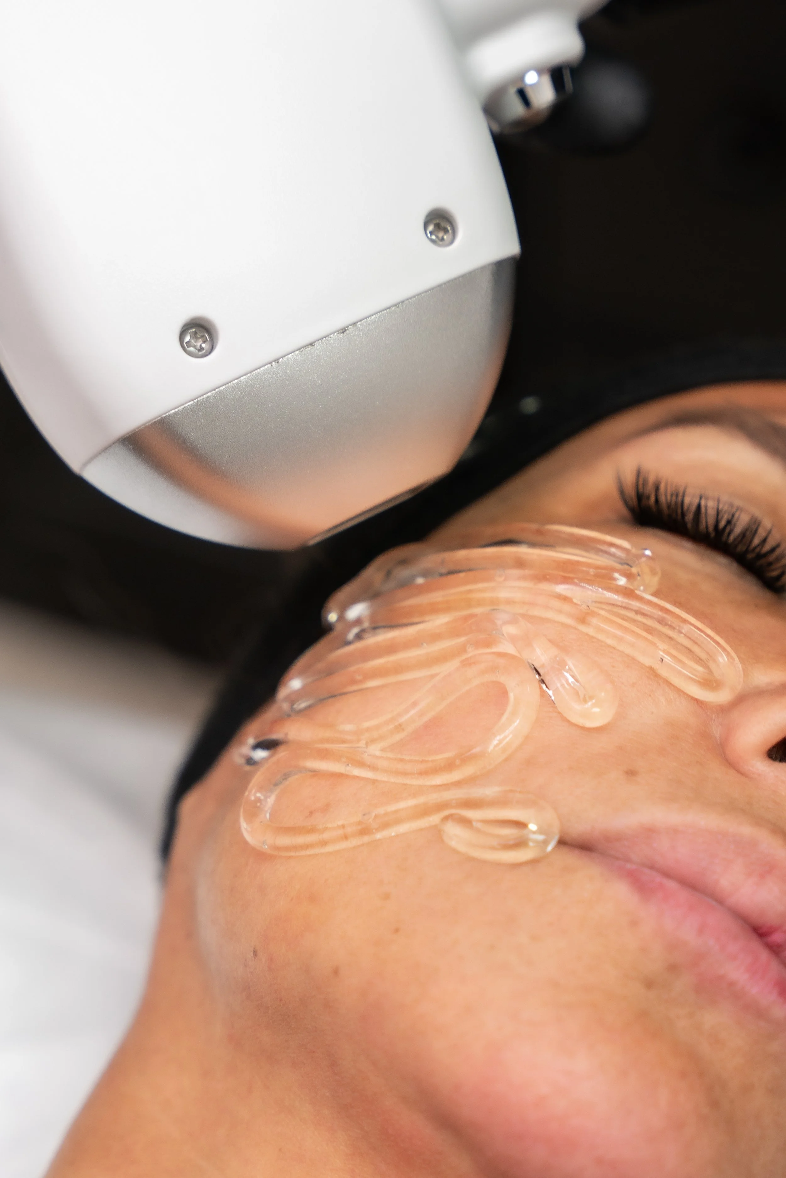 Close-up of a client with closed eyes receiving a diode hair removal treatment on her face.