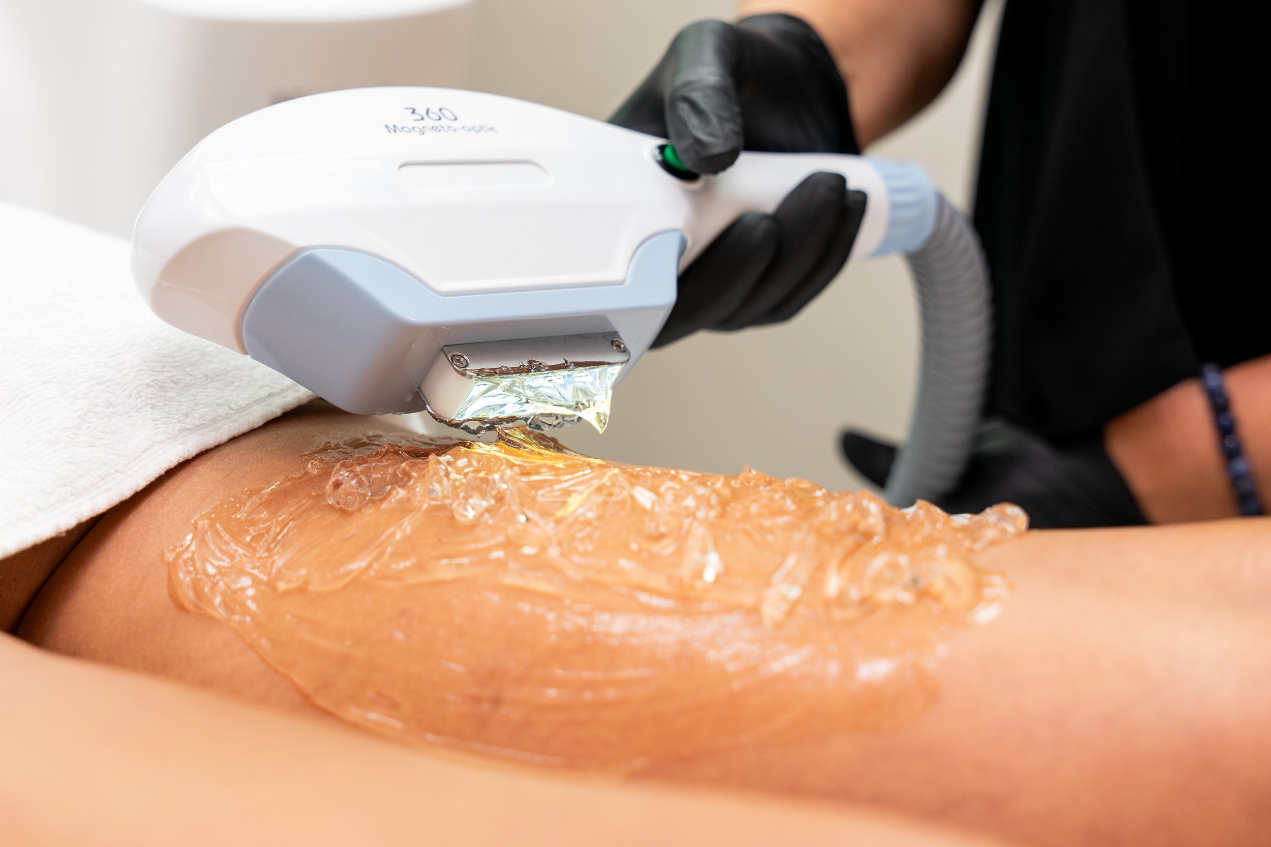 Client receiving IPL treatment on the legs, with a technician wearing black gloves operating the handpiece at Wakashe Spa