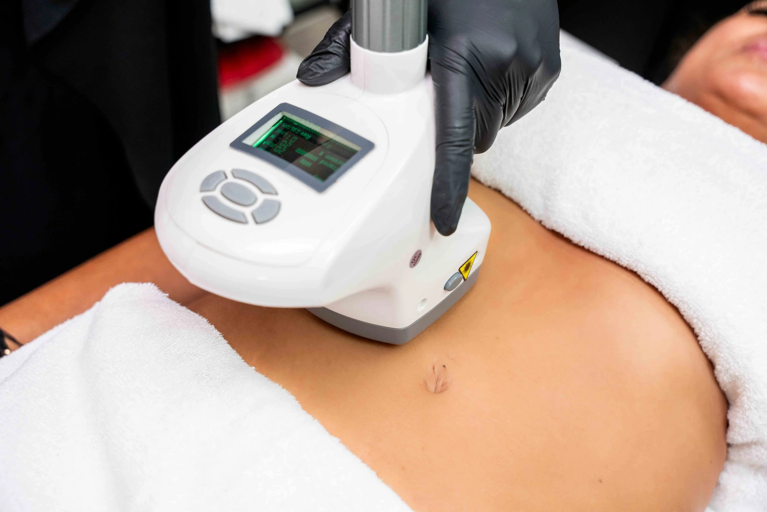 Client receiving a Velashape treatment on the abdomen at Wakashe Spa, with a black-gloved hand operating a handheld device.