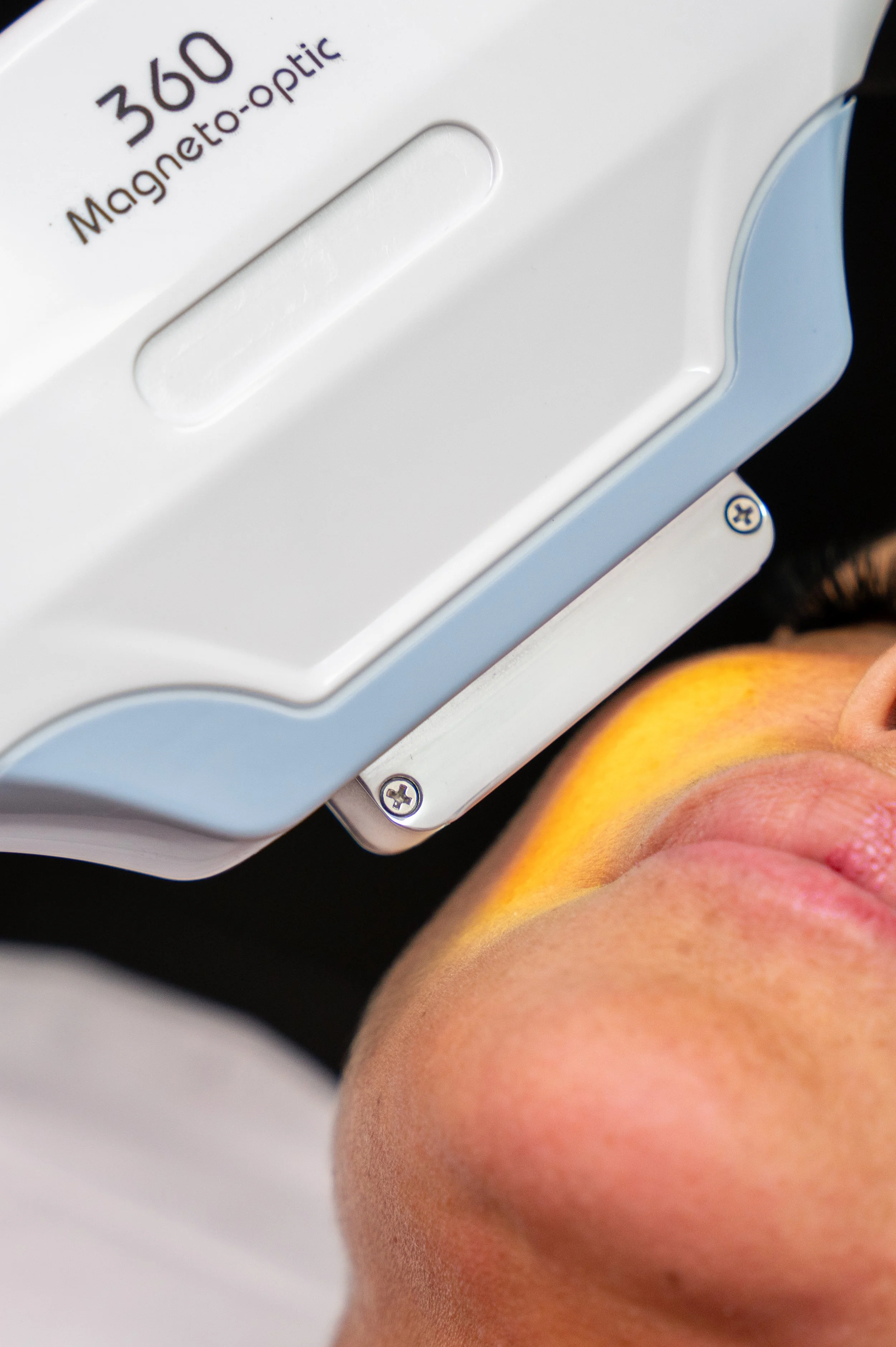 Close-up of a client receiving a ipl treatment on her face.