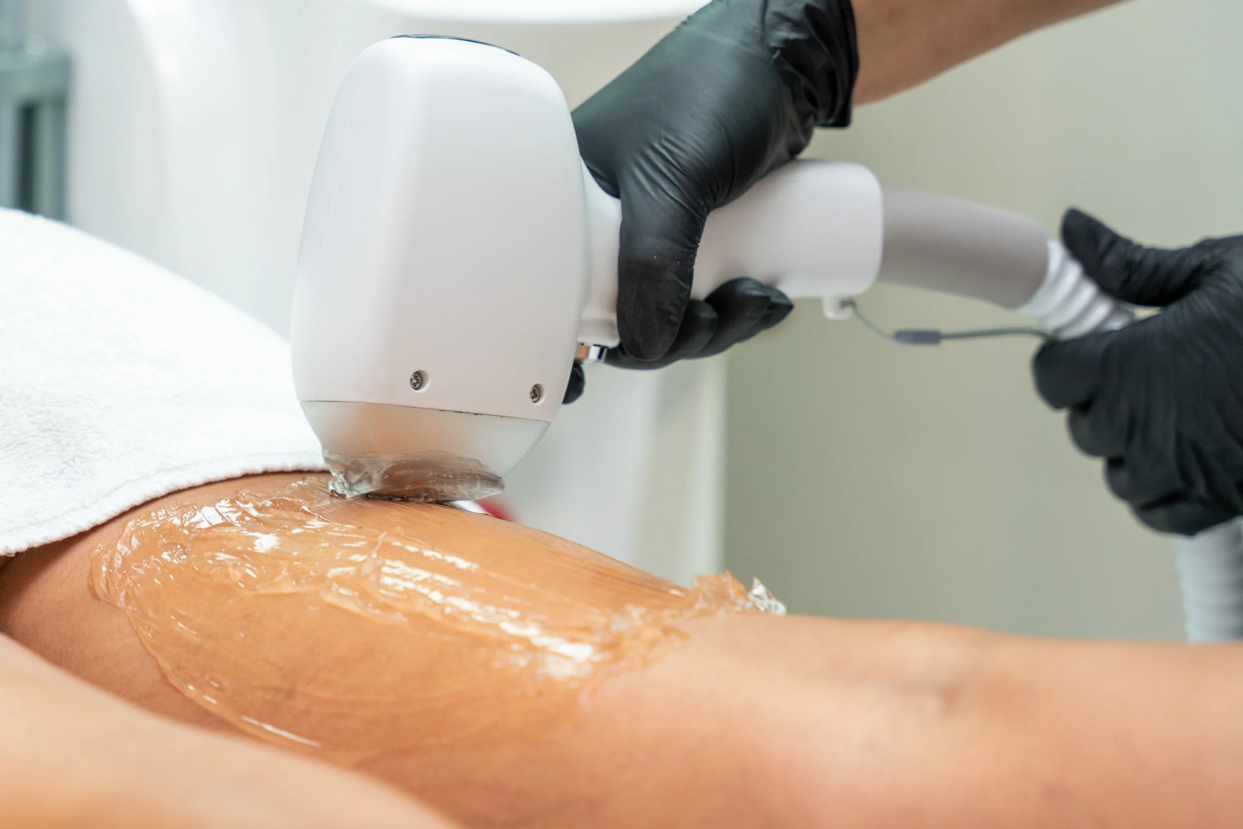 A client receiving a diode hair removal treatment on her legs, with a technician wearing black gloves operating the device.