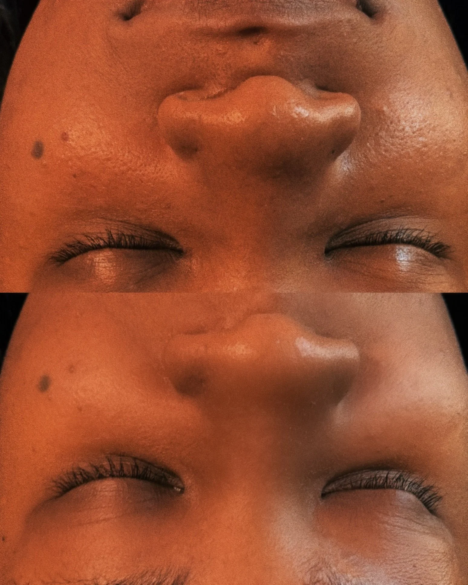 Close-up of a person's face focusing on the nose and closed eyes, with visible skin texture and small moles.