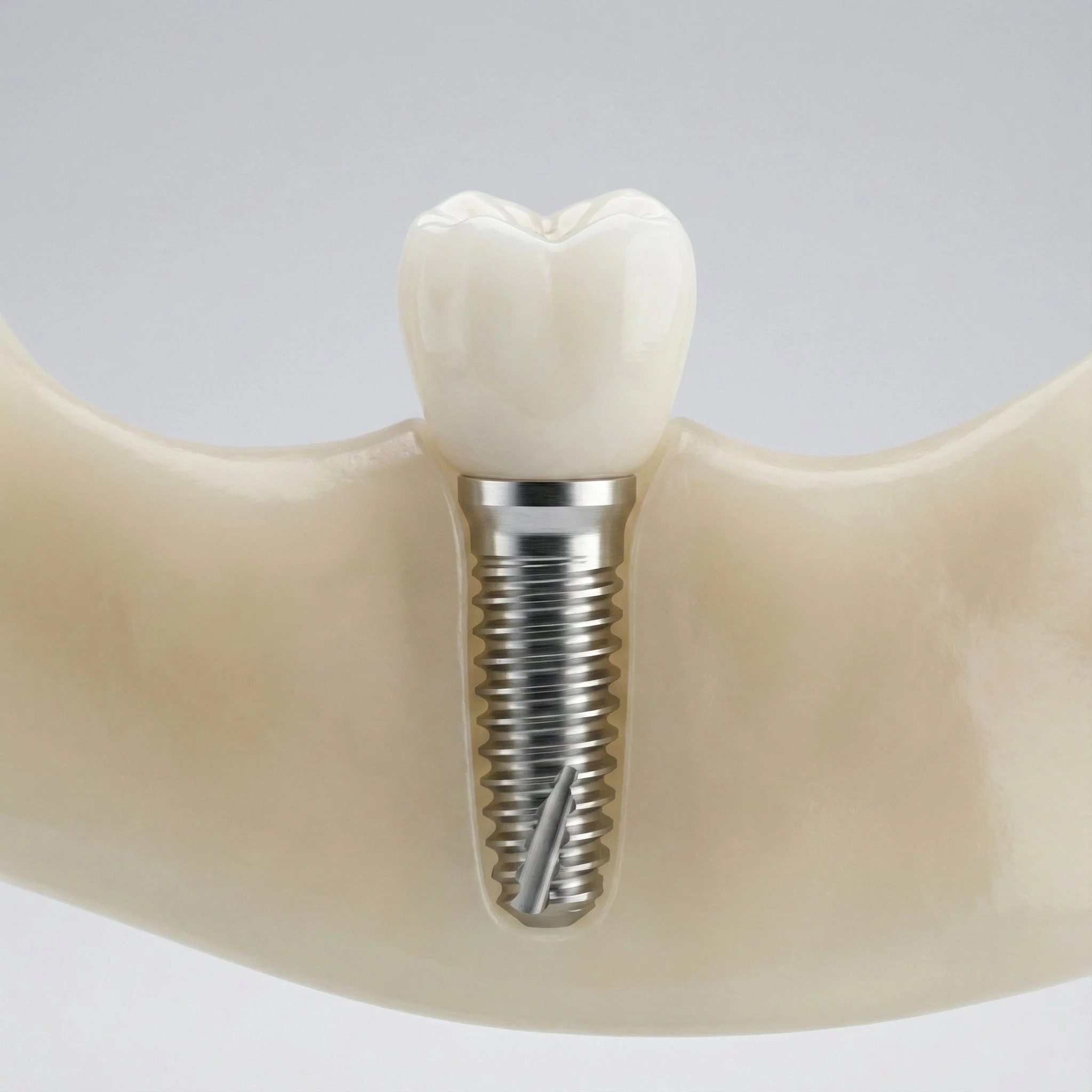 dental implants, implantes dentales