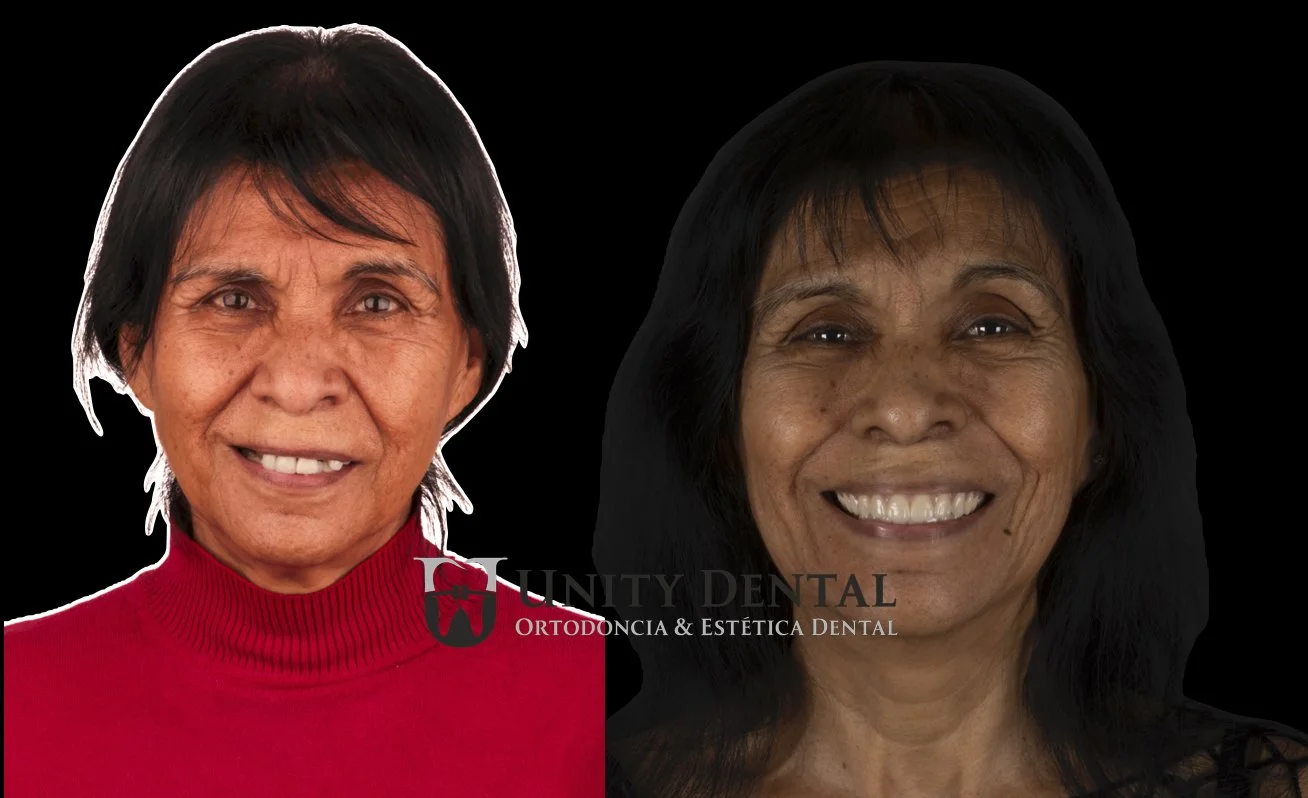 Before and after images of dental work demonstrating improved tooth shape, absence, position, and smile at Unity Dental in Mexicali. The procedure was done with All-on-6 treatment.