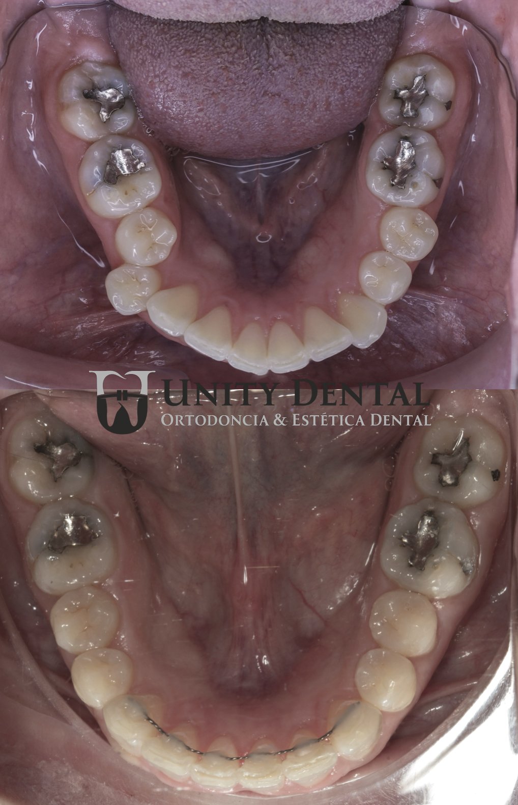 Before and after photos of a dental procedure showing the results with Clear Aligners like Invisalign or ClearCorrect; the second photo shows the lower teeth after a dental treatment with a fixed retainer at Unity Dental in Mexicali