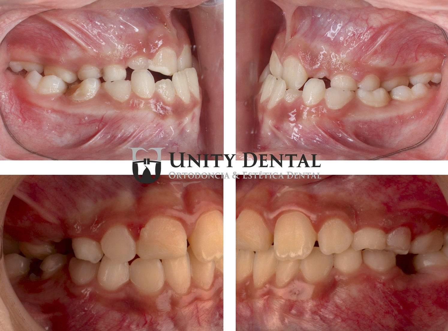 Before (top) and after (bottom) of a young patient's dental condition with misaligned teeth, crowding, and malocclusion, shown from multiple angles. This at Unity Dental in Mexicali