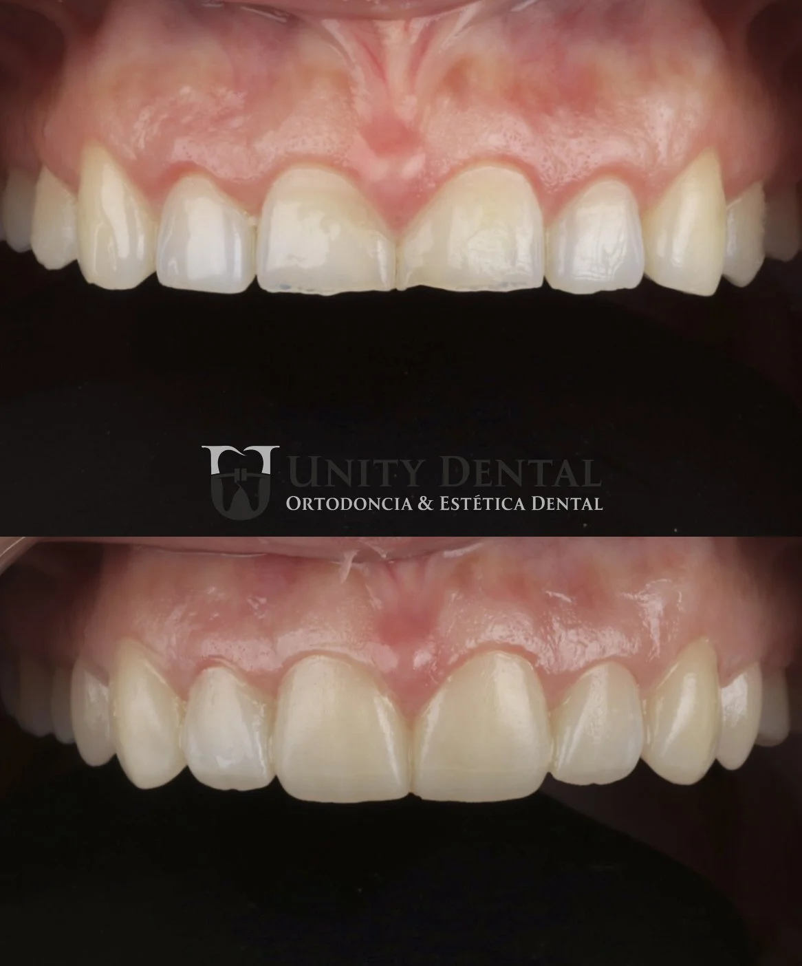 Comparison of teeth before and after dental veneers treatment showing improved alignment and appearance in Unity Dental