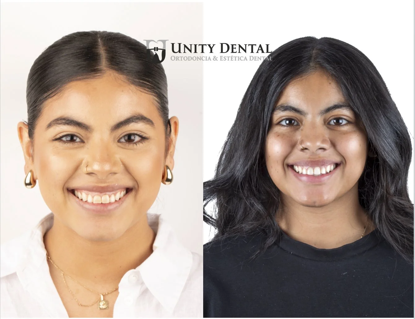 Side-by-side comparison photo of two a woman after finishing her Orthodontic treatment at Unity Dental