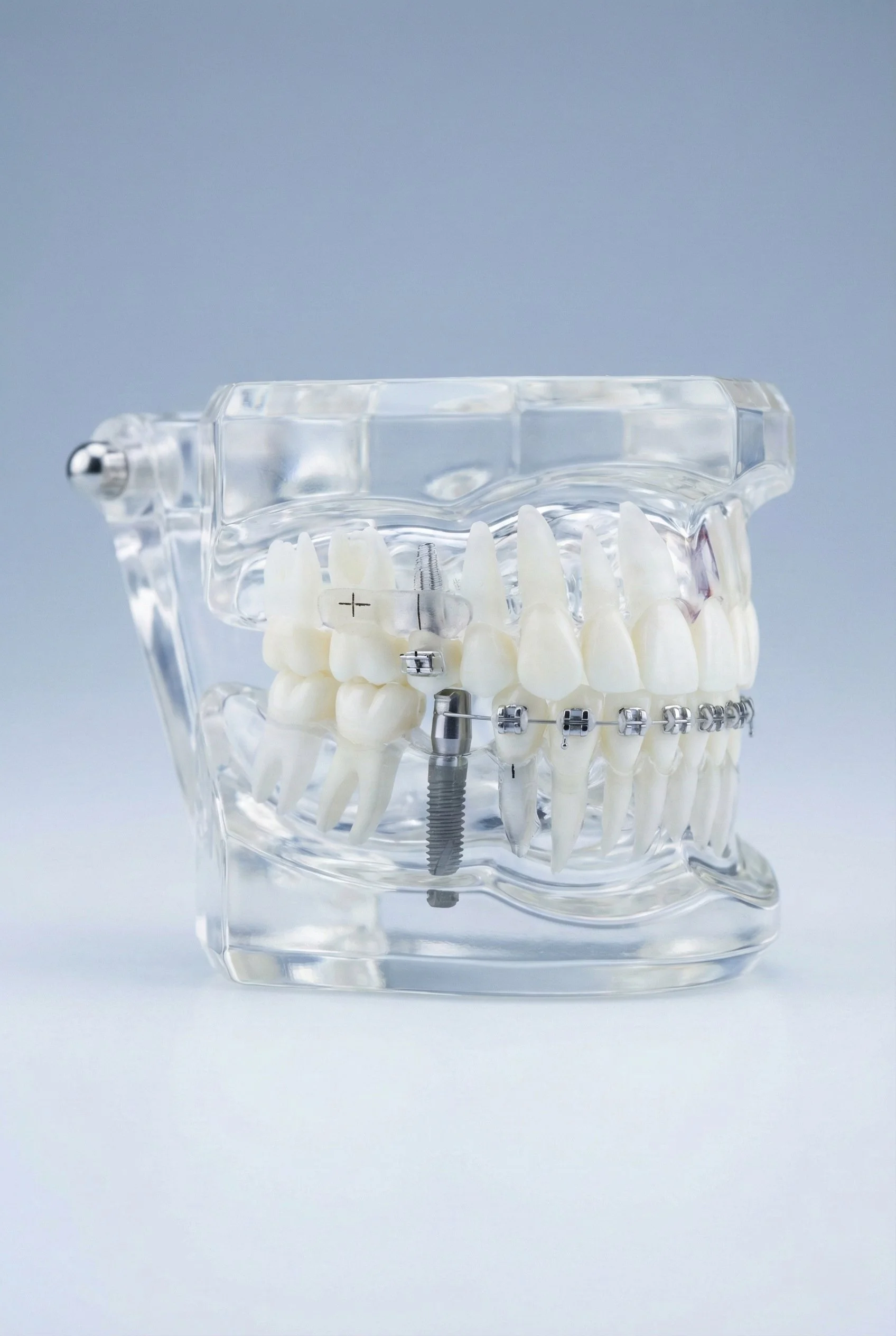 Dental model with artificial teeth, braces, and orthodontic appliances, set on a clear stand against a light blue background.