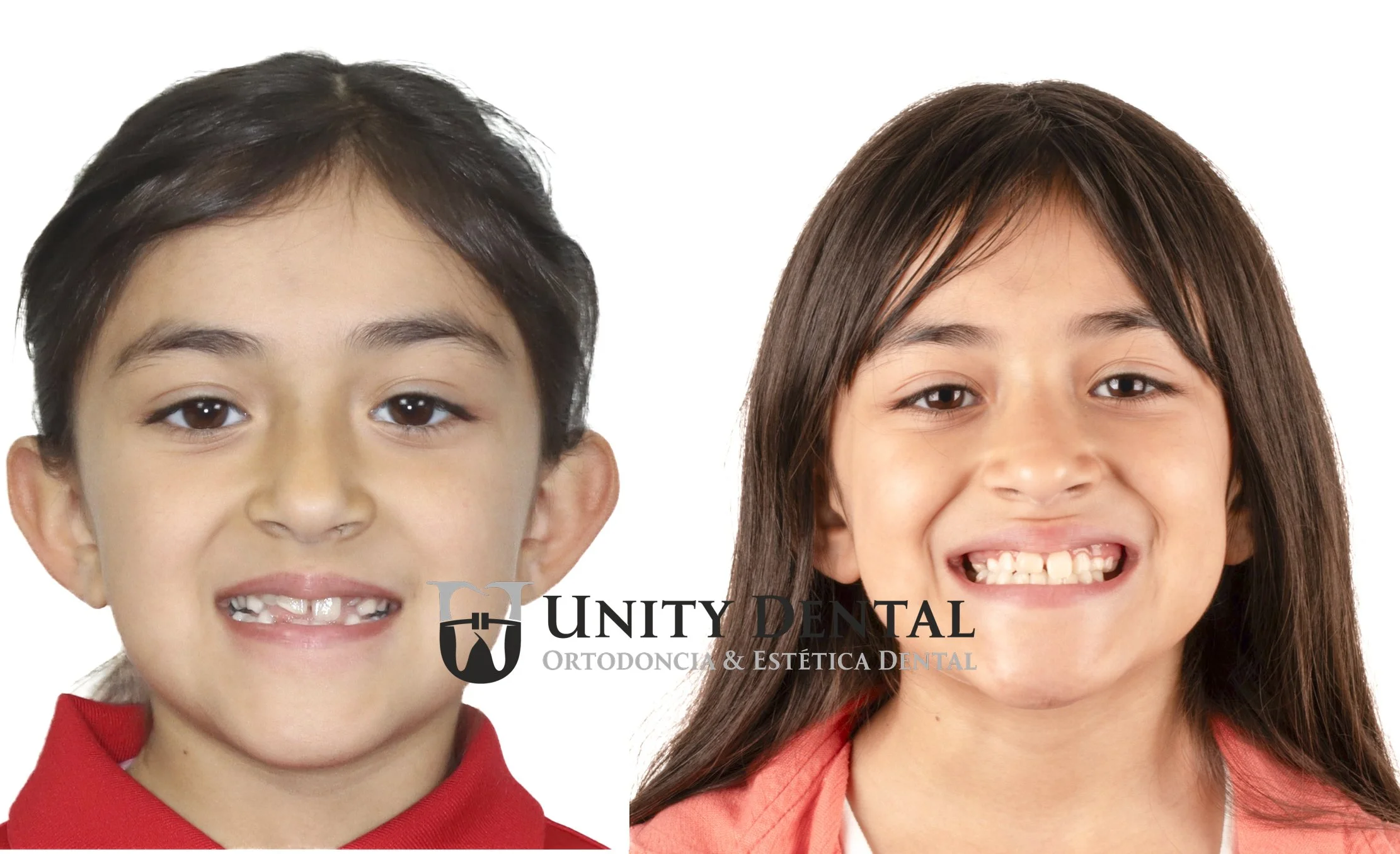 A photo comparison of a girl before and after Orthopedic treatment with expander showing better smile, teeth space for eruption, esthetic profile and smile, this at Unity Dental in Mexicali
