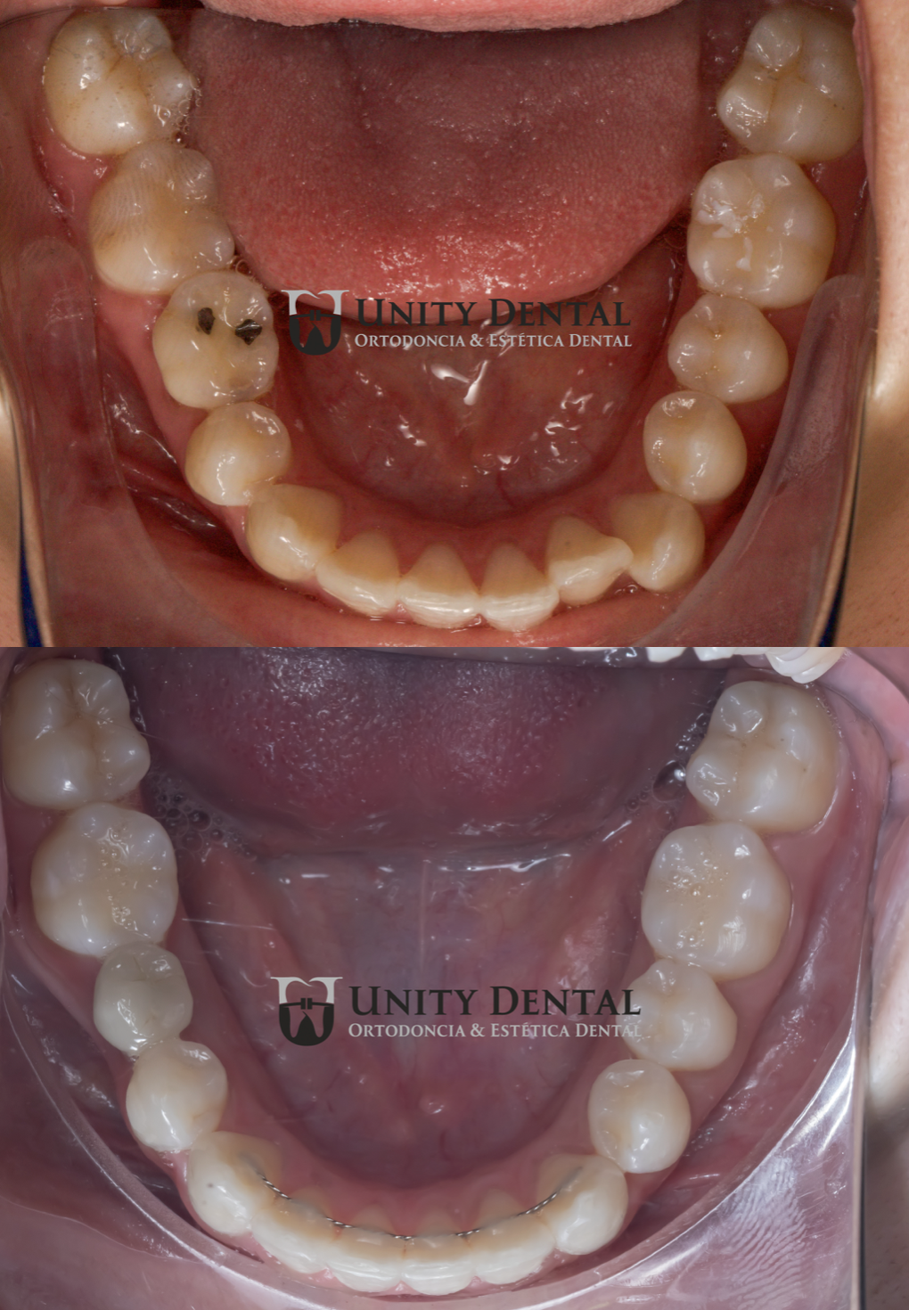 Comparison of lower teeth before and after Orthodontic  treatment with self-ligating braces at Unity Dental. 