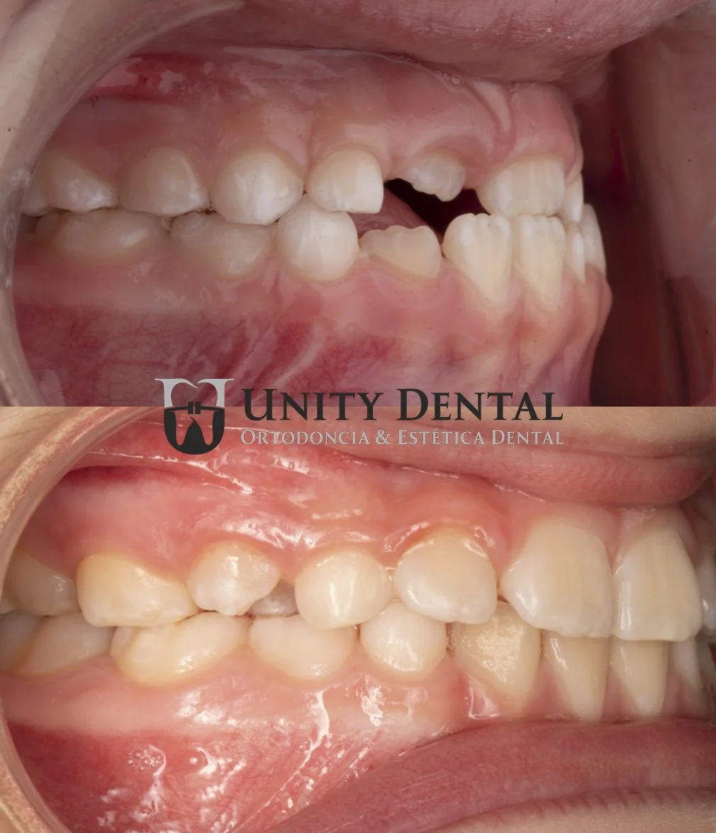 Close-up of a person's teeth showing dental alignment before and after orthodontic treatment, with the upper and lower teeth visible at Unity Dental in Mexicali