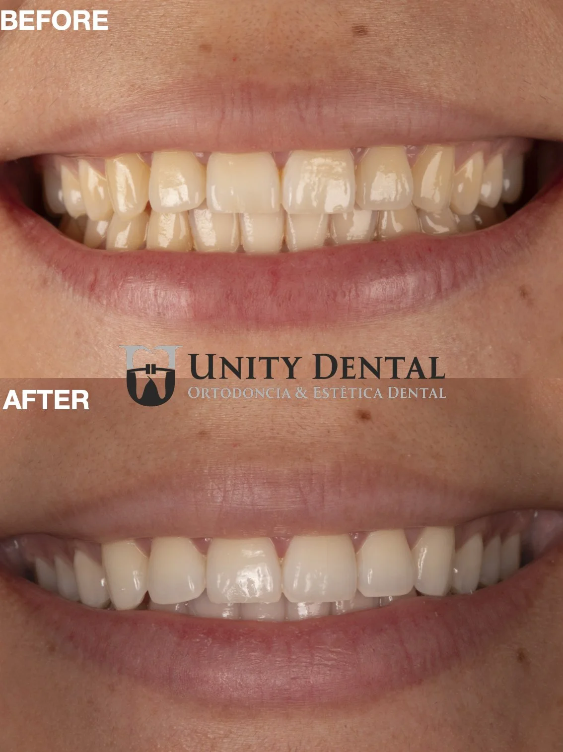 Close-up of a person's teeth before and after dental treatment, showing improved whiteness at Unity Dental in Mexicali