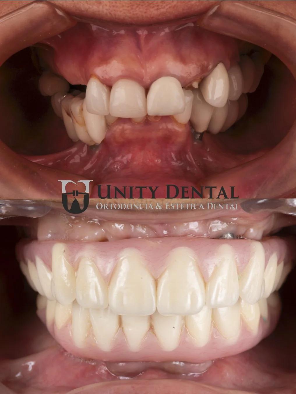 Before and after images of dental work demonstrating improved tooth shape, absence, position at Unity Dental in Mexicali. The procedure was done with All-on-6 treatment