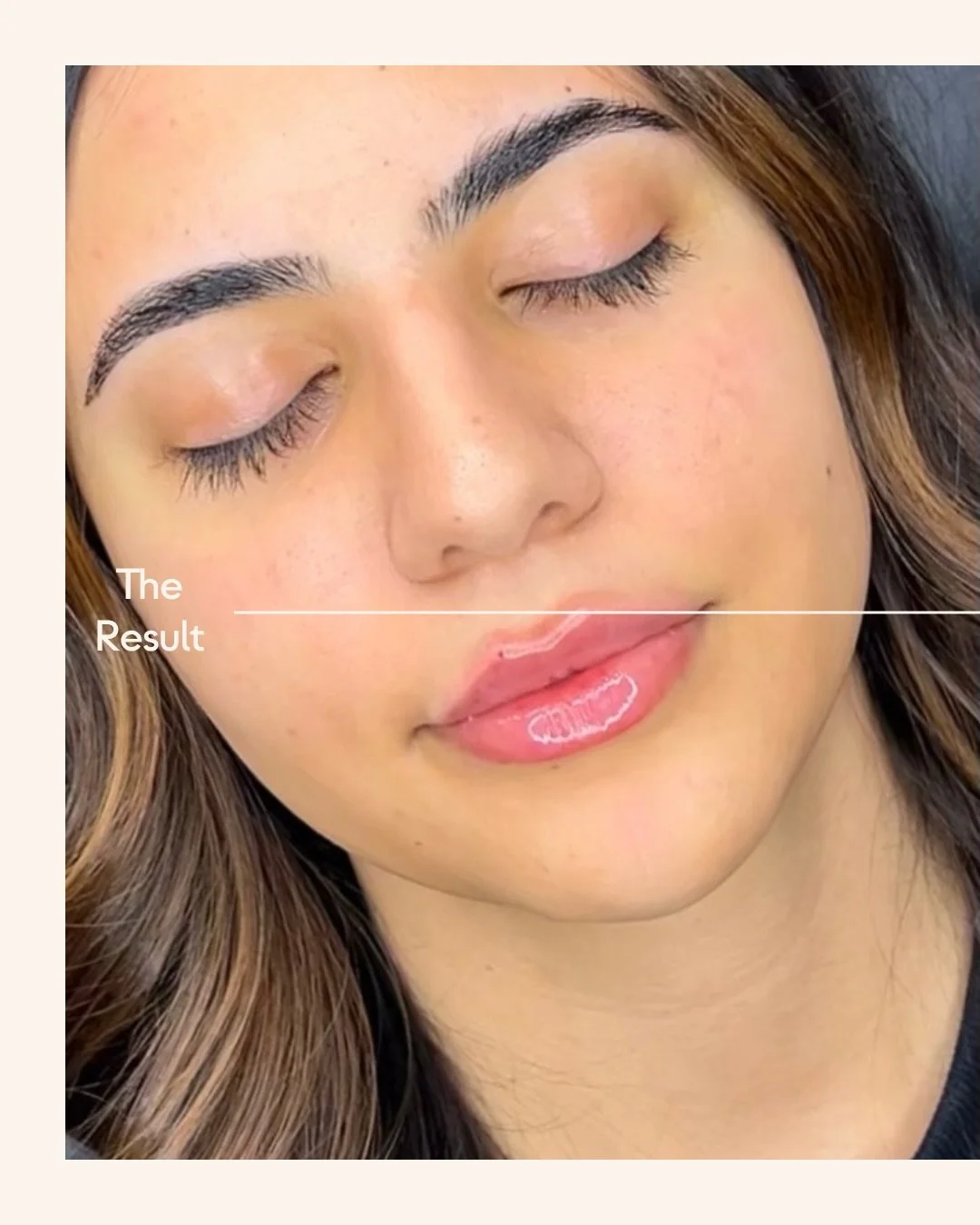 The perfect little pout. Book your next filler appointment through the link in bio! 💋