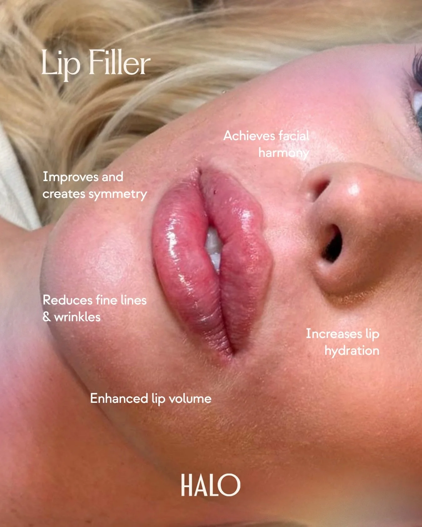When thoughtfully placed, filler can be used to enhance the lips you already have&mdash;whether that means restoring lost volume, improving symmetry, defining the lip shape, softening the appearance of fine lines, or adding subtle hydration and suppo