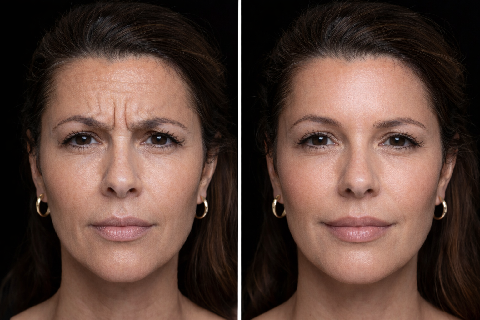 Botox before and after facial rejuvenation results