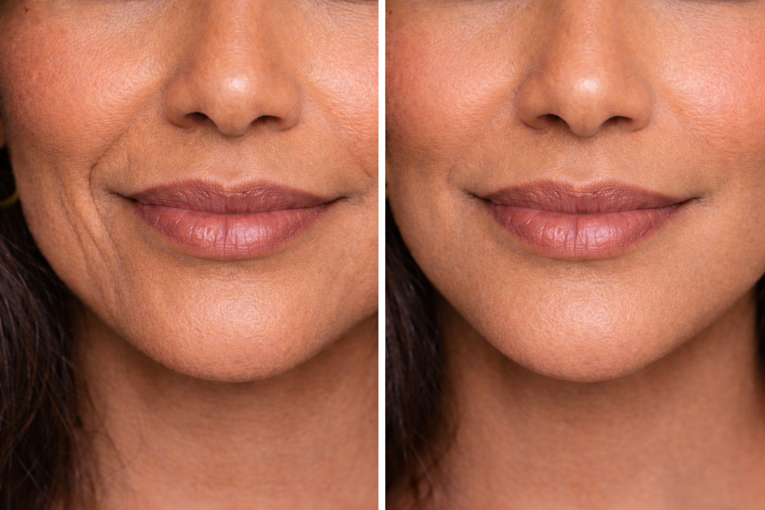Nasolabial folds before and after hyaluronic acid filler treatment
