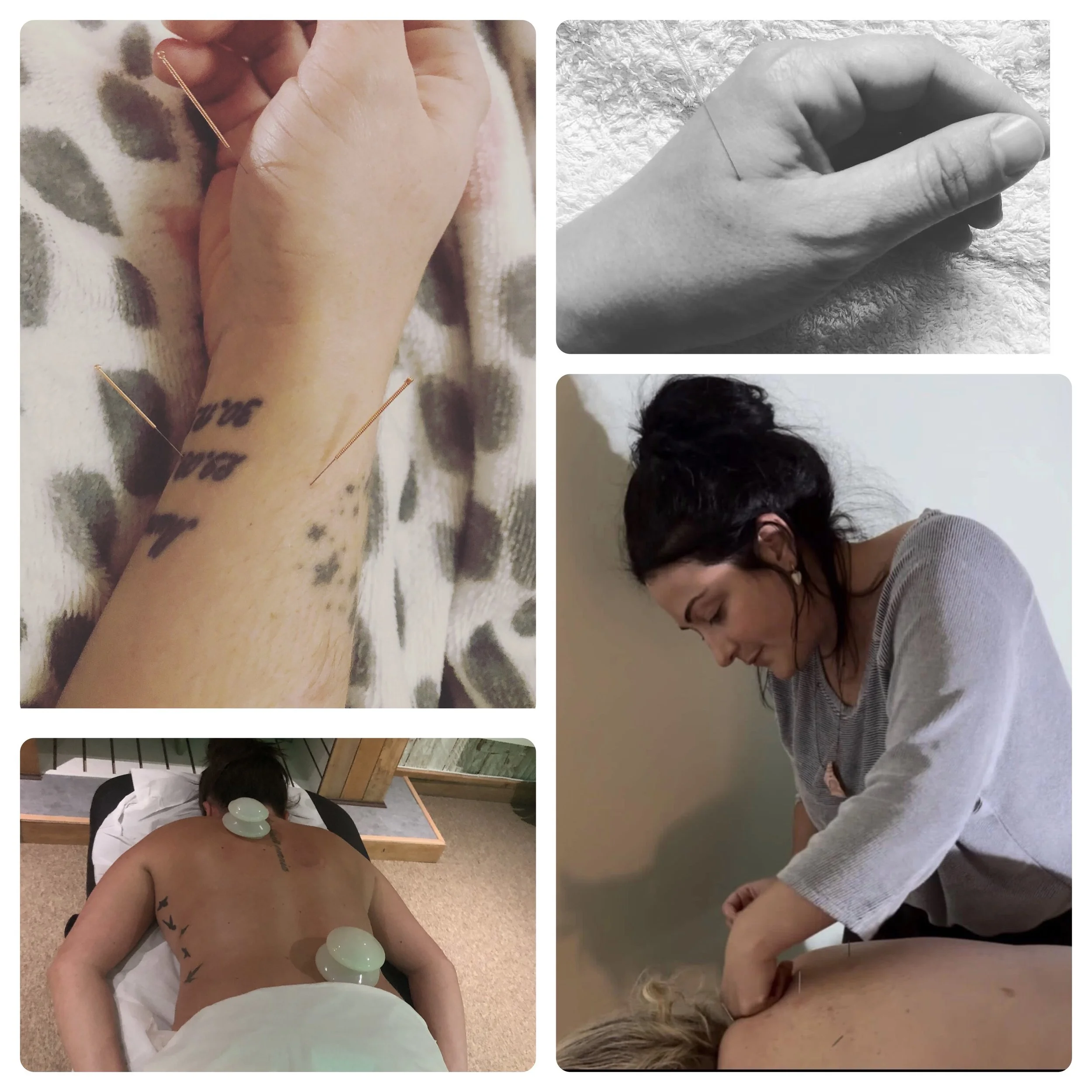 Compilation of five images showing acupuncture treatments: close-up of a person's wrist with acupuncture needles, hand with a single acupuncture needle, woman receiving acupuncture in her back, person lying face down with acupuncture needles and cups on their back, and a patient's back with multiple acupuncture needles.