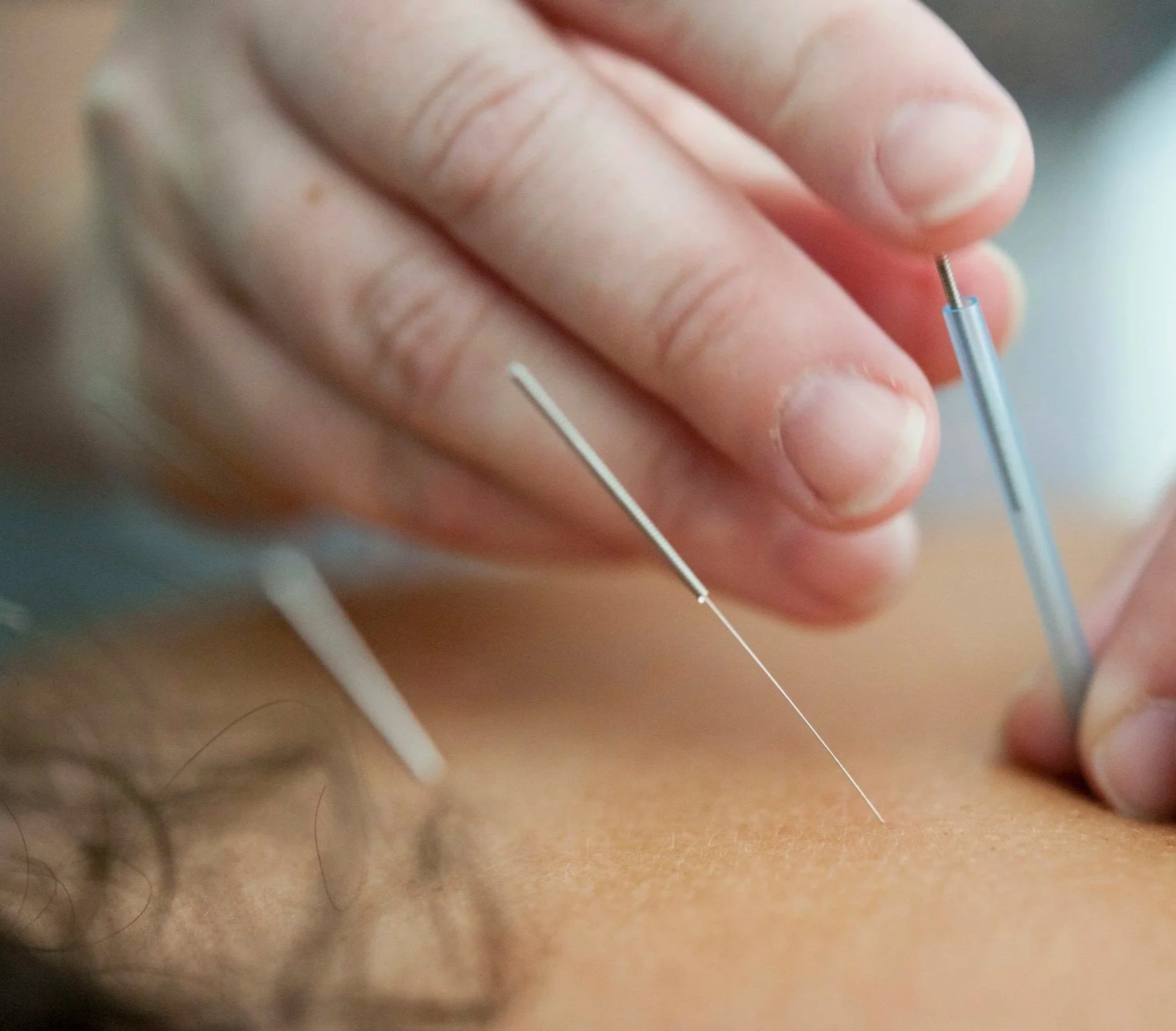 close up photo of acupuncture needle being inserted into skin