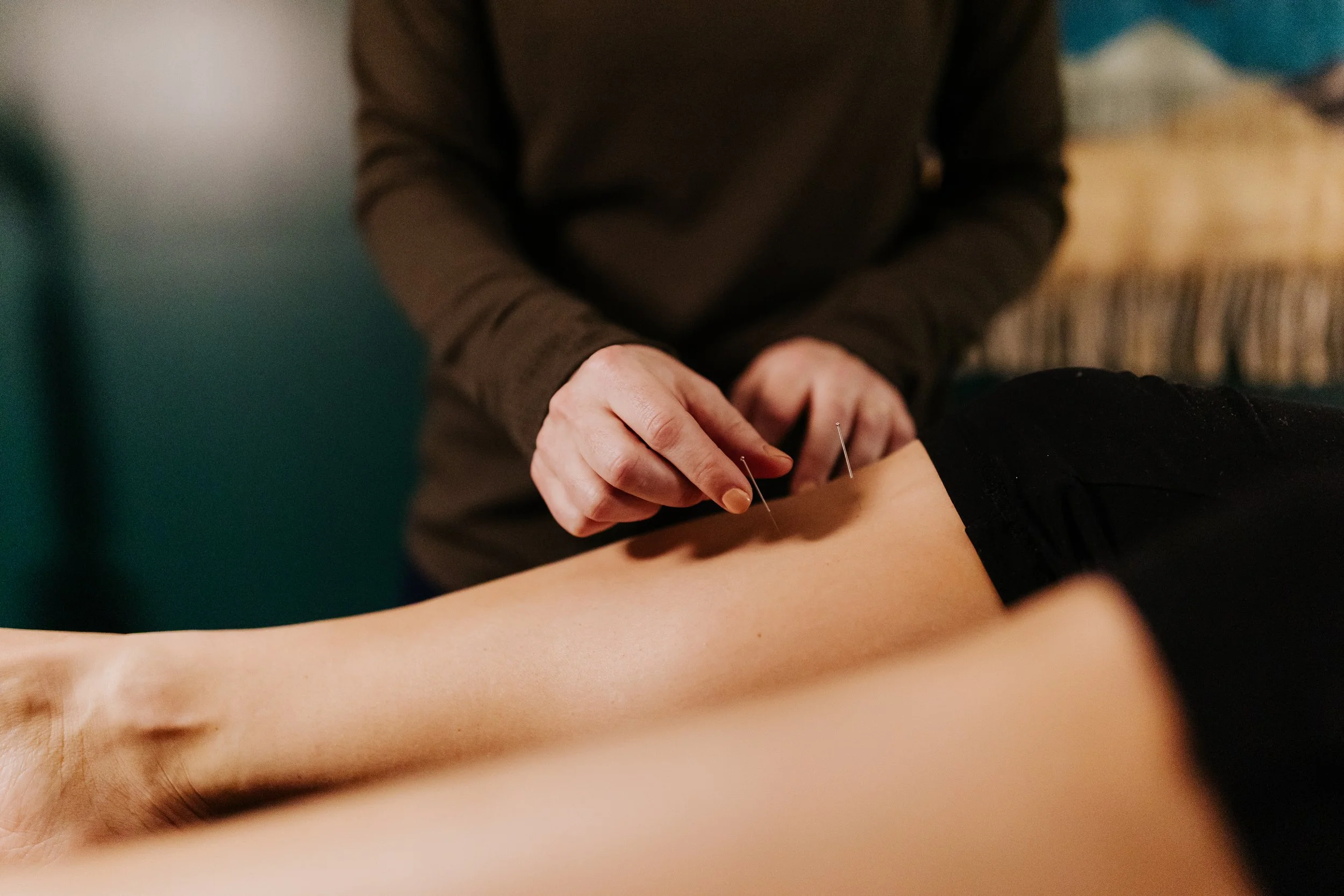 Photograph of 2 acupuncture needles being place by a woman's hand.