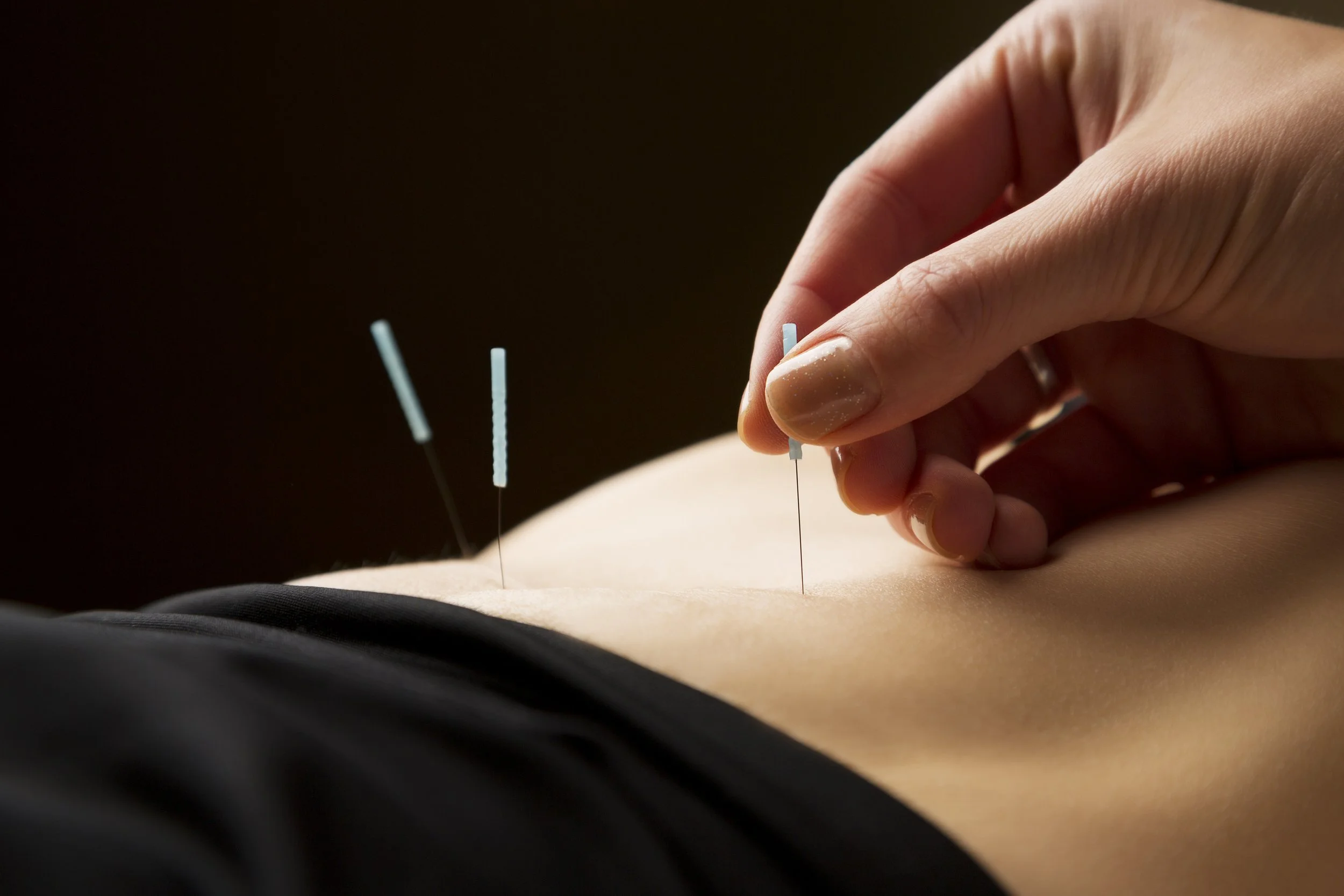 Close up photograph of a hand inserting acupuncture needles into a patient's low back.