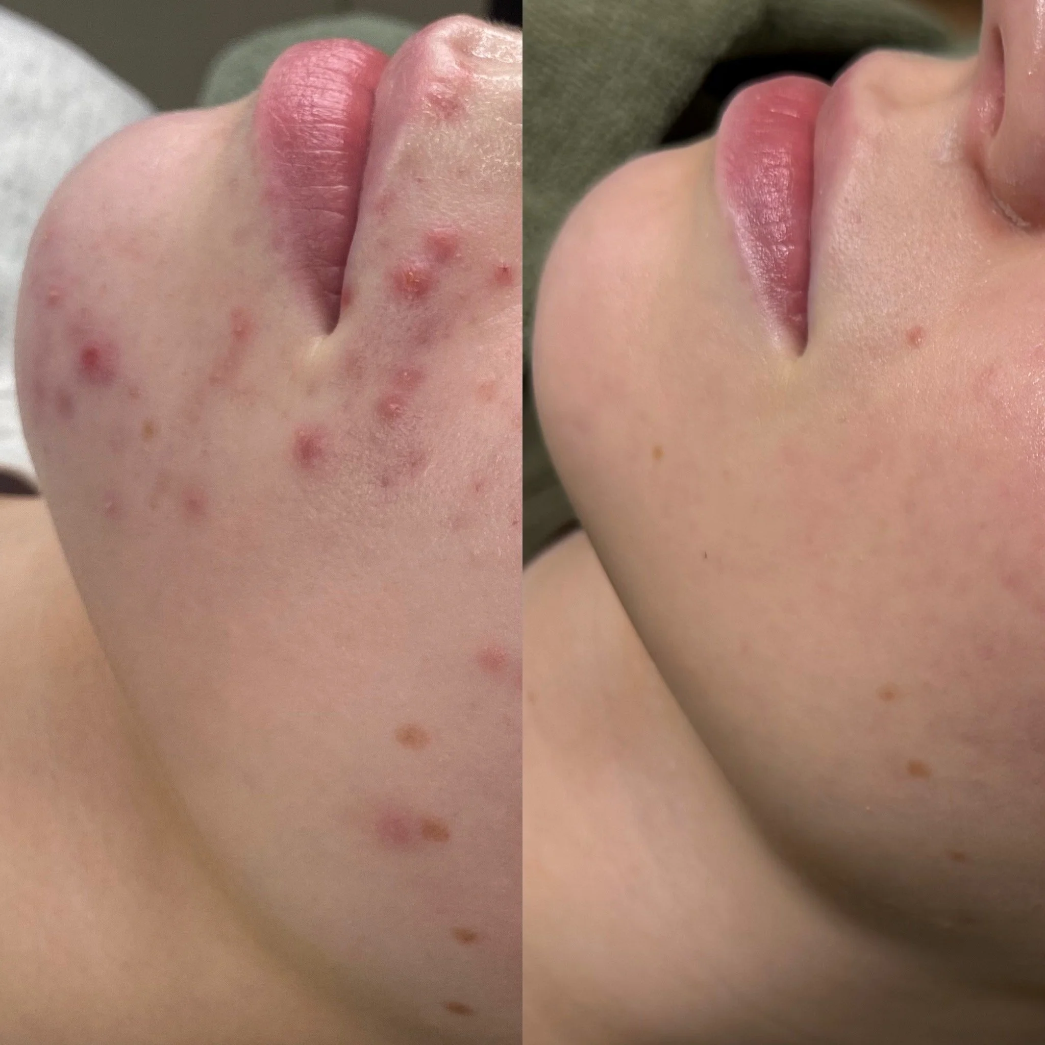 Acne Start -etäpalvelu ja sen jälkeen yksilöllinen tuotekokonaisuus kotona.