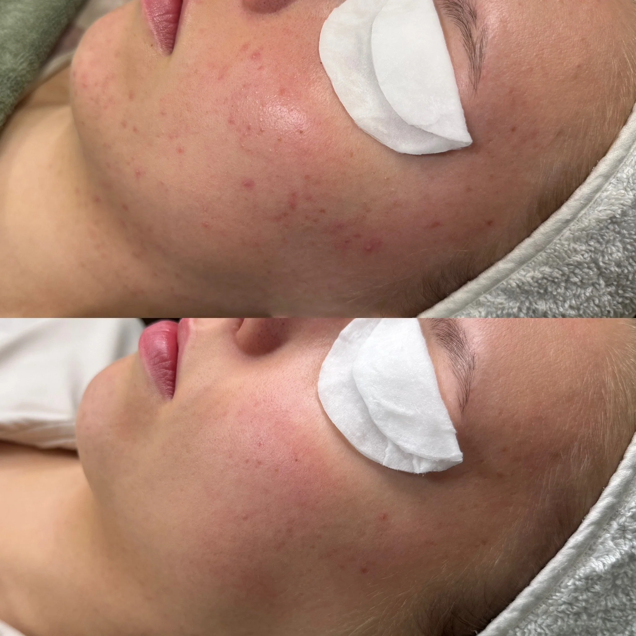 Yksi kasvohoito ja Acne Start kauneushoitolassa.