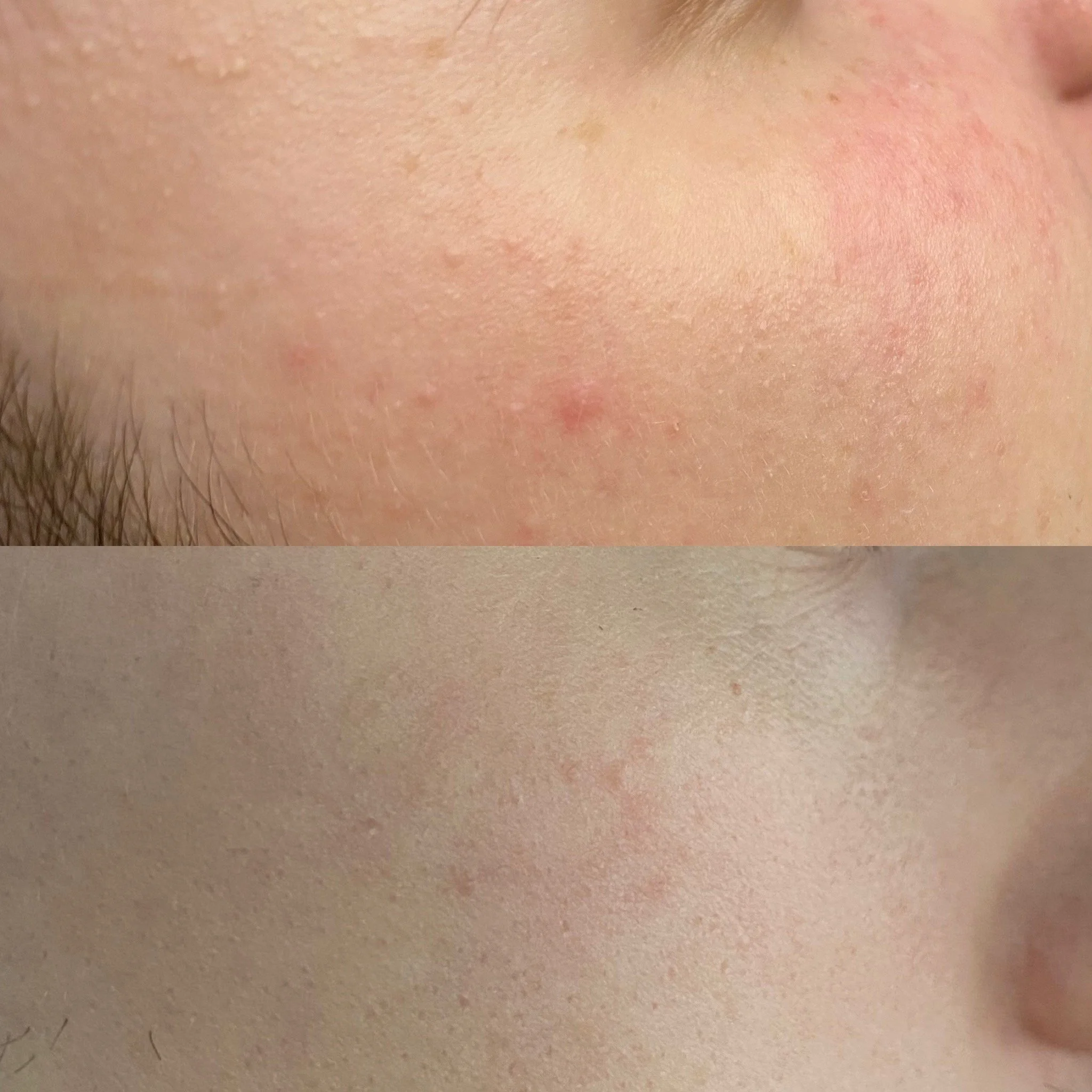 Ruusufinnin oireiden hallinta etänä.