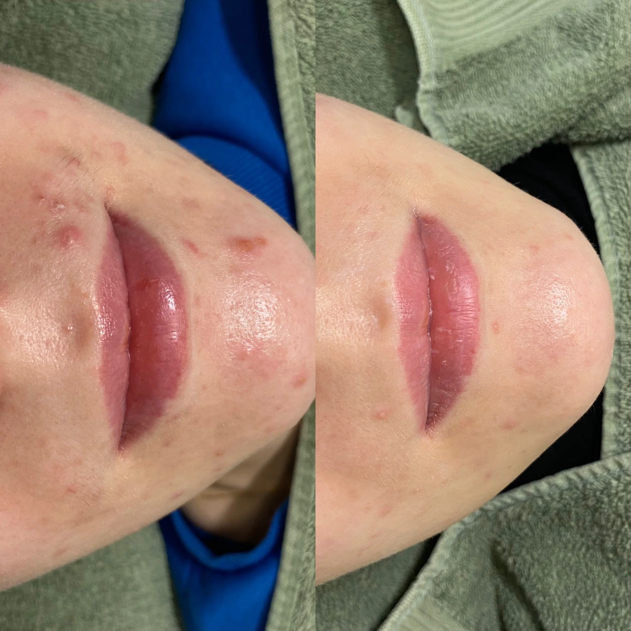 Kemiallinen kuorinta -sarjahoito kauneushoitolassa sekä yksilöllinen tuotekokonaisuus kotona.